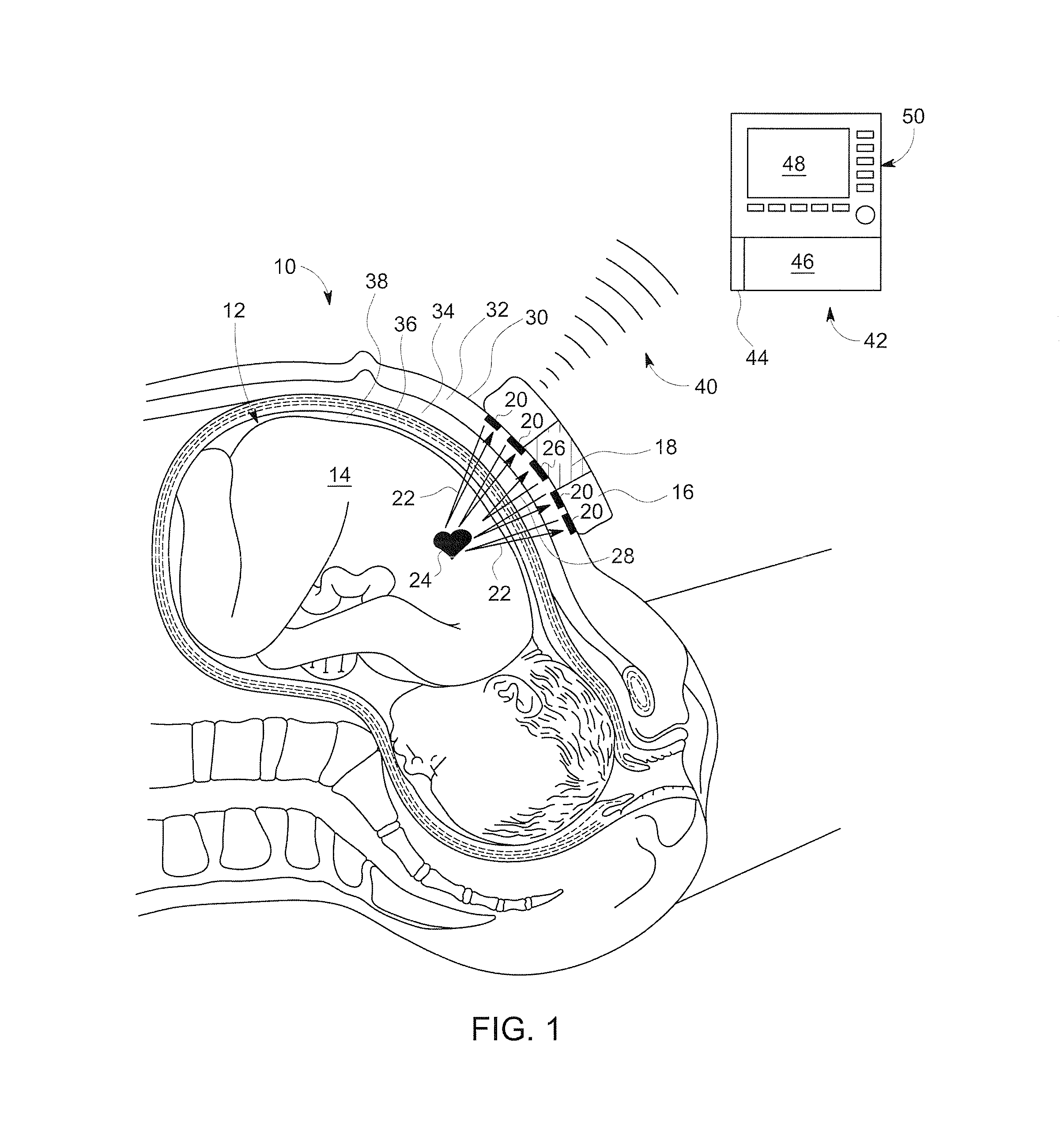 Abdominal sonar system and apparatus