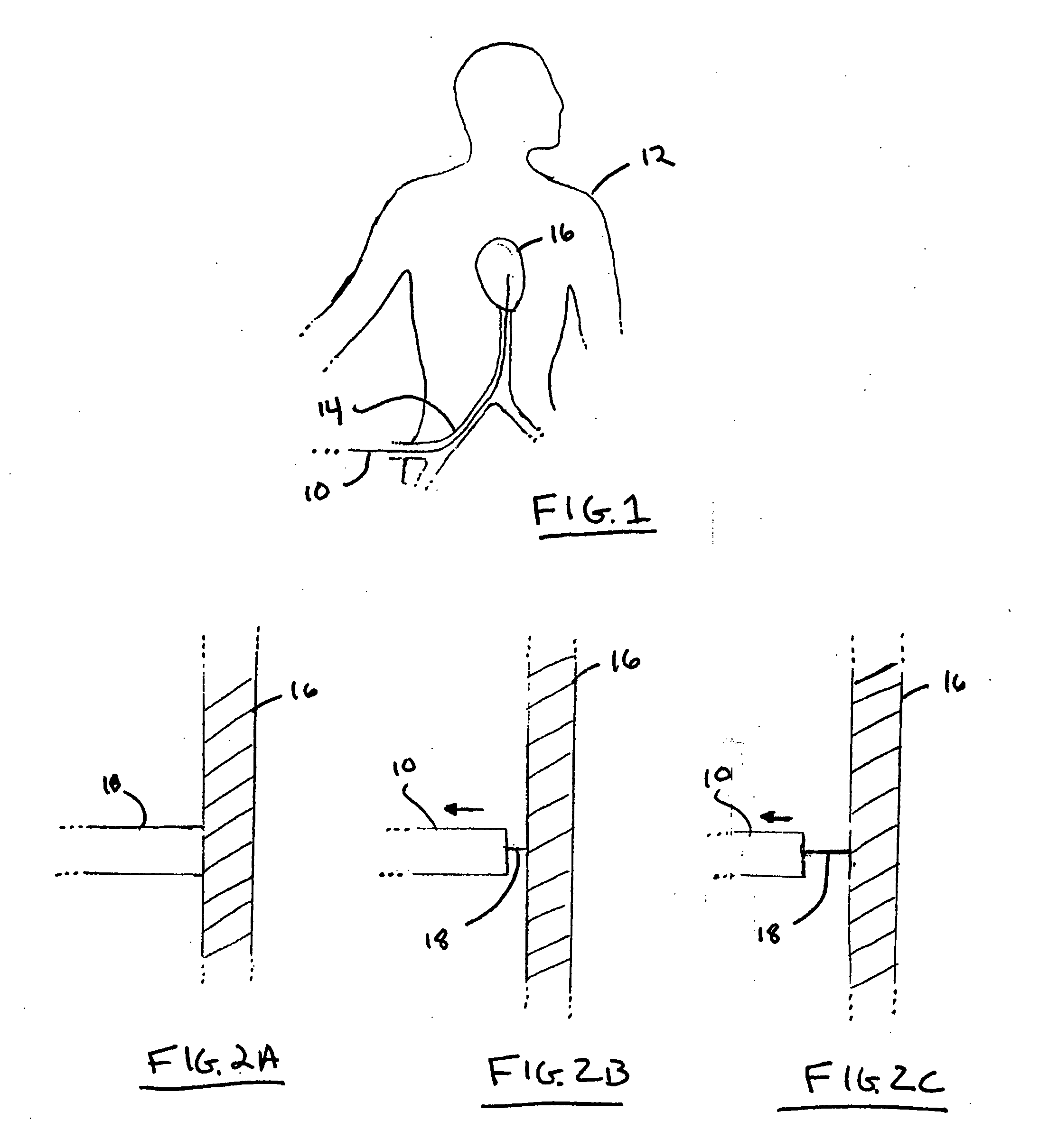 Biopsy and injection catheters