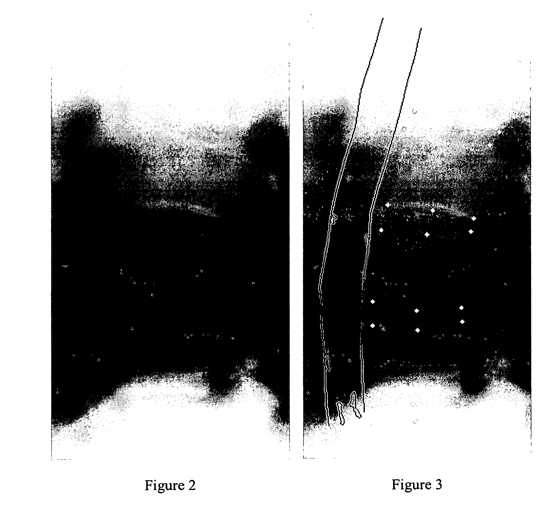 Method of deriving a quantitative measure of the instability of calcific deposits of a blood vessel