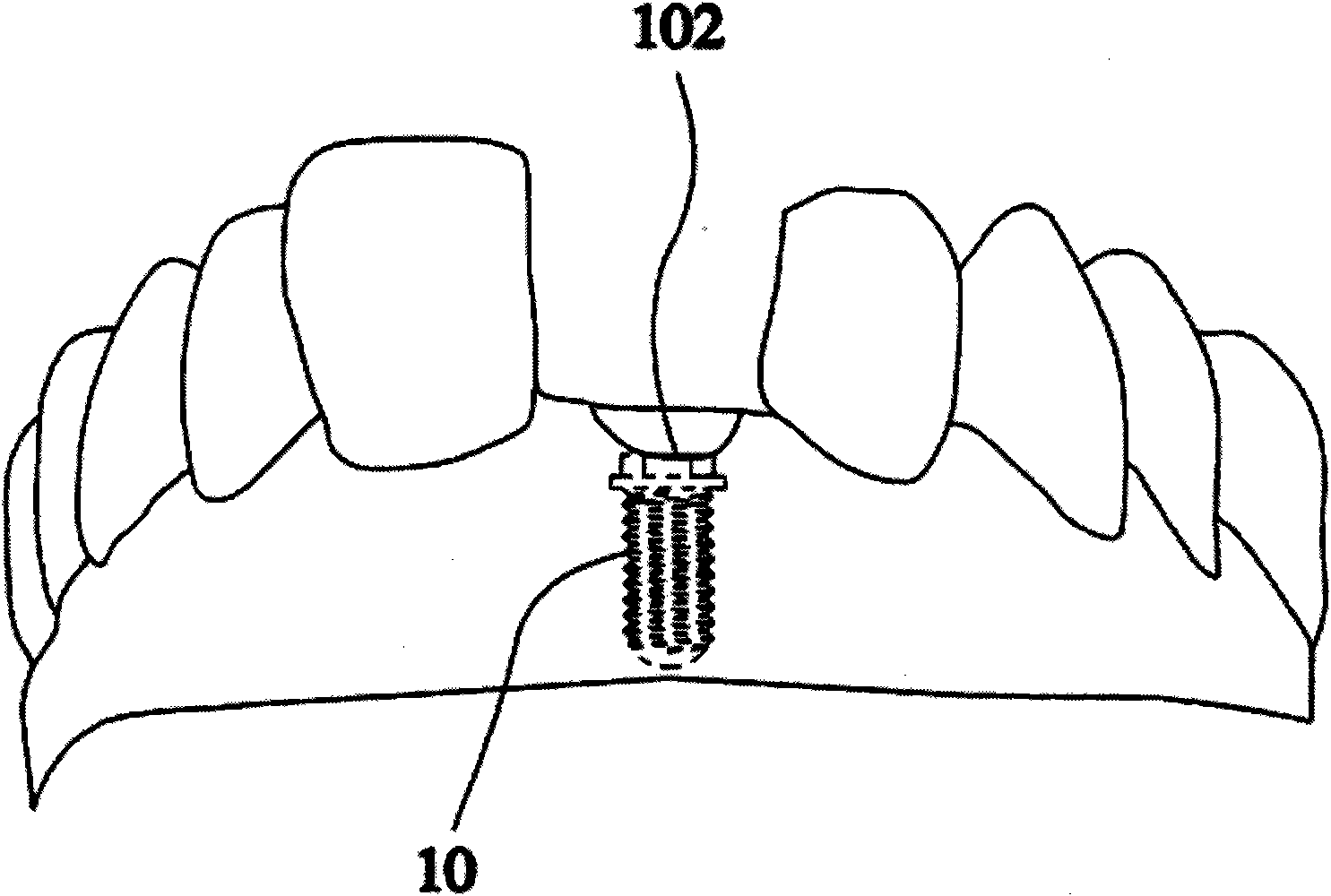 Method for producing digital model applied to dental implant and method for producing artificial teeth