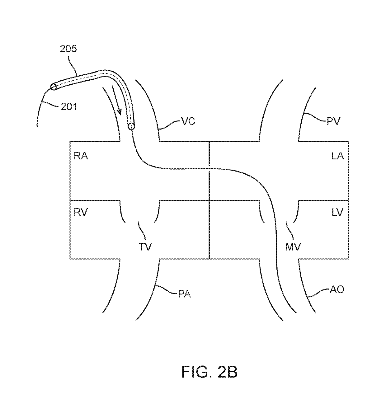 Antegrade hemodynamic support