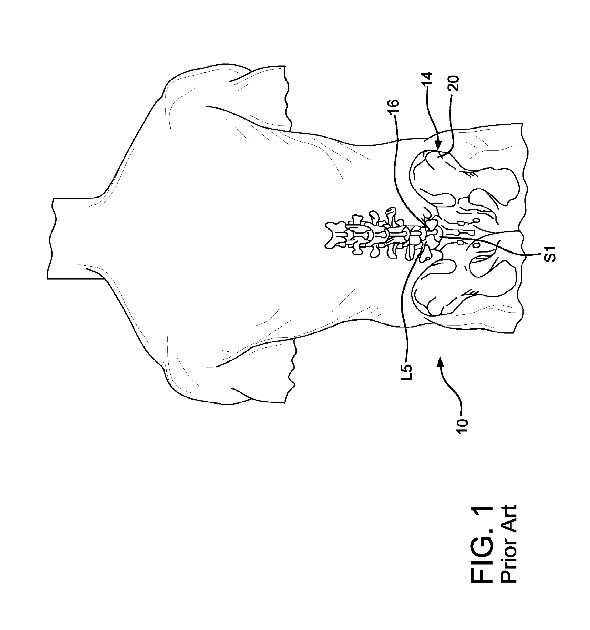 Method and apparatus for laterally accessing an intervertebral disc space