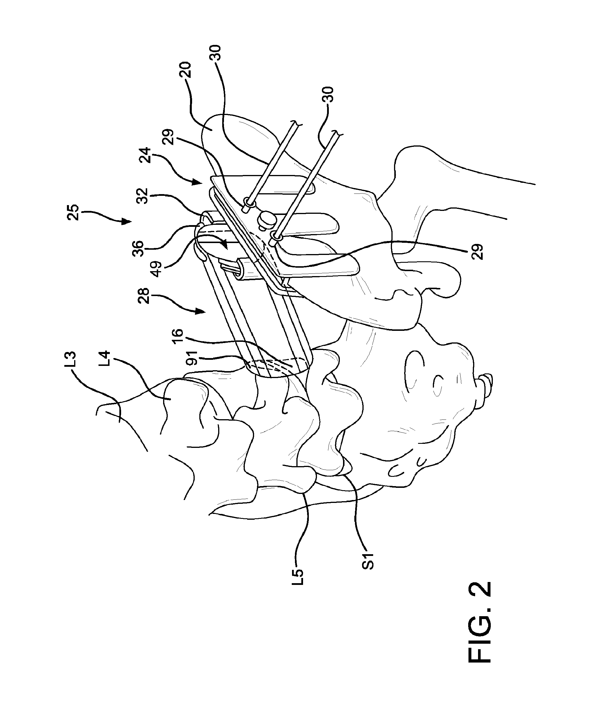 Method and apparatus for laterally accessing an intervertebral disc space