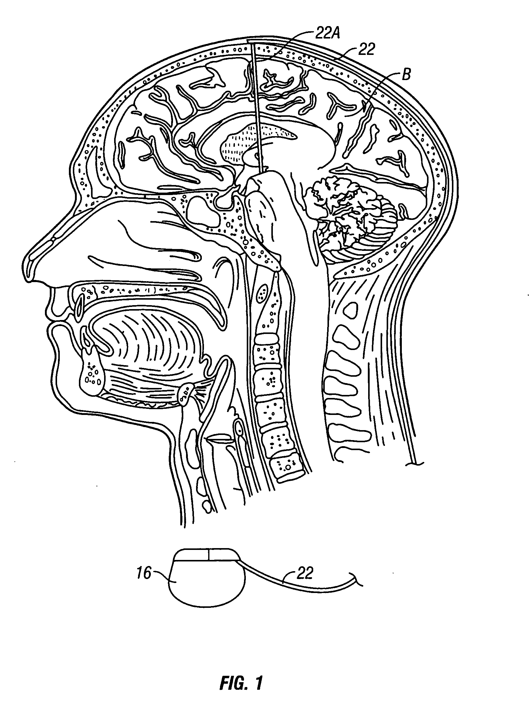 System and method of treating stuttering by neuromodulation