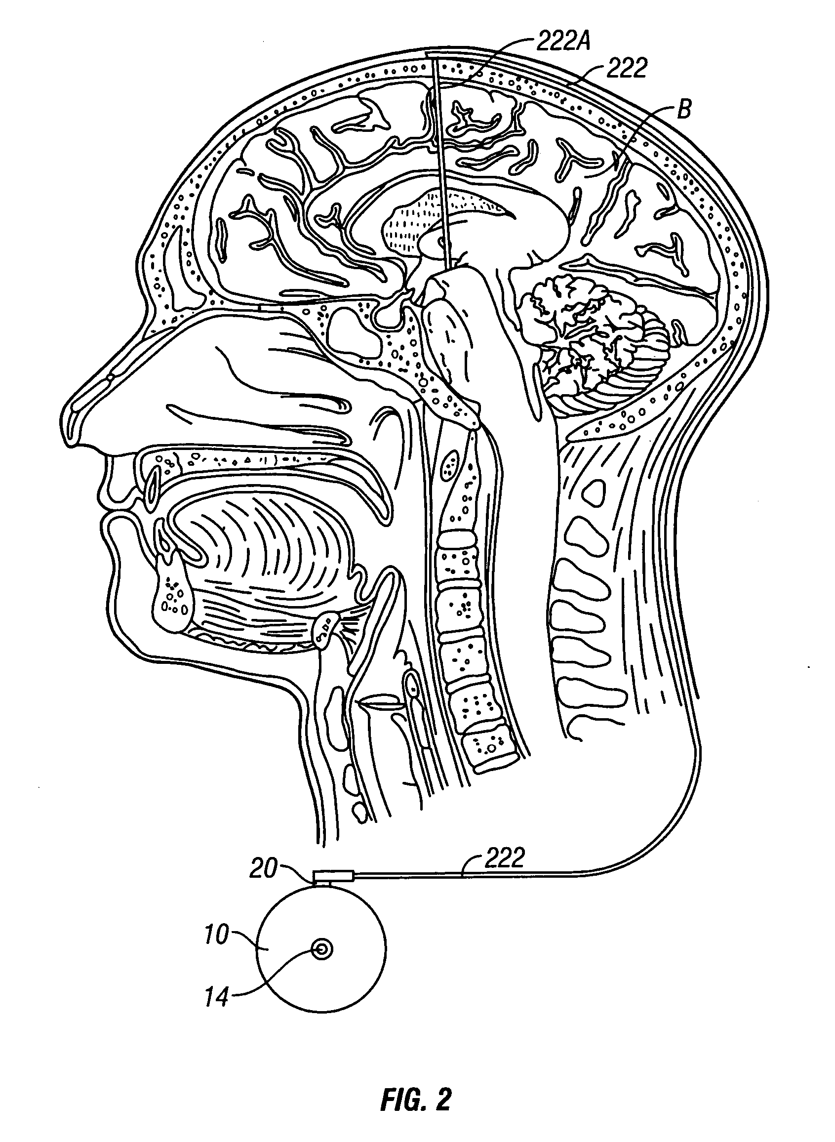 System and method of treating stuttering by neuromodulation