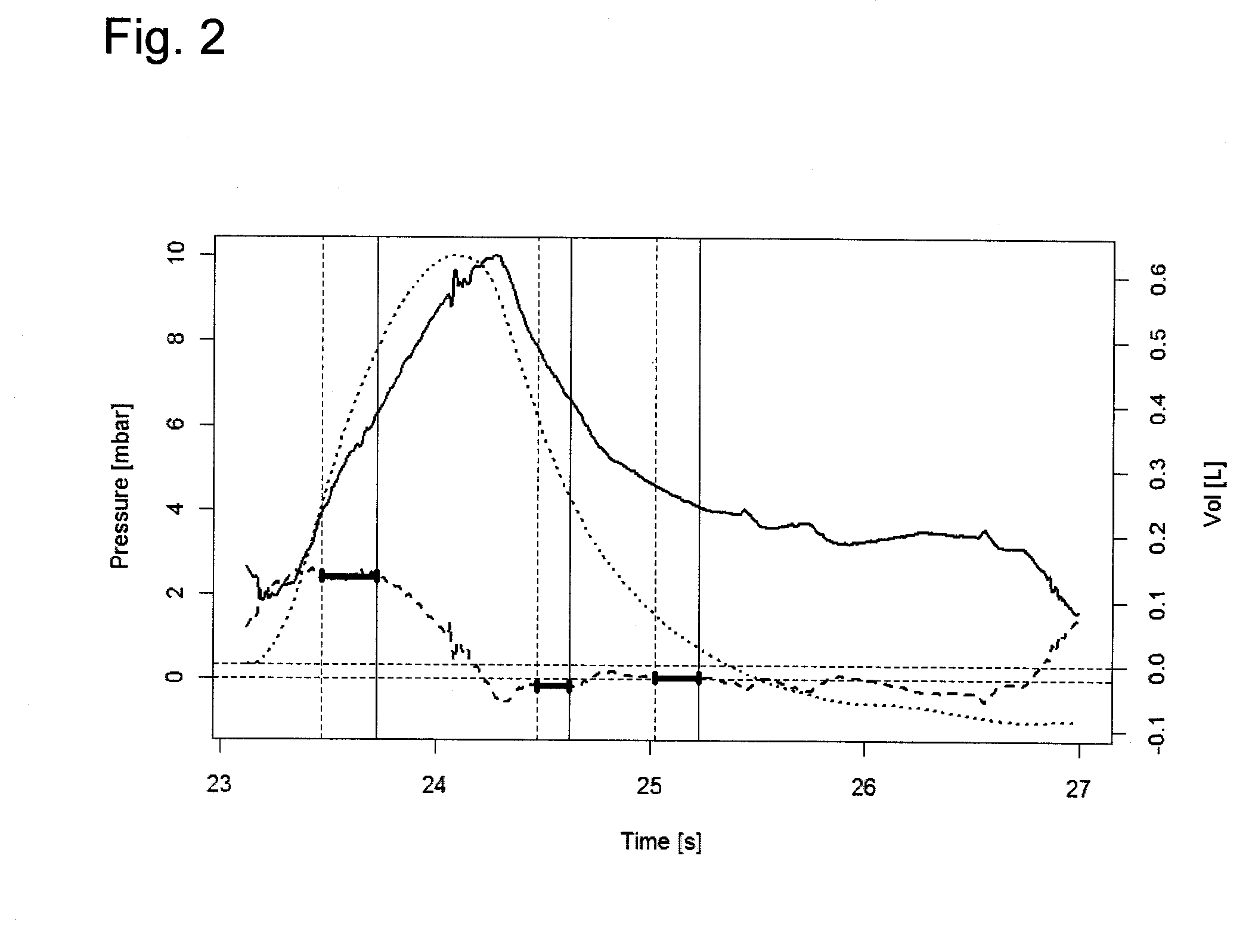 Respirator with automatically controlled pressure-assist respiration