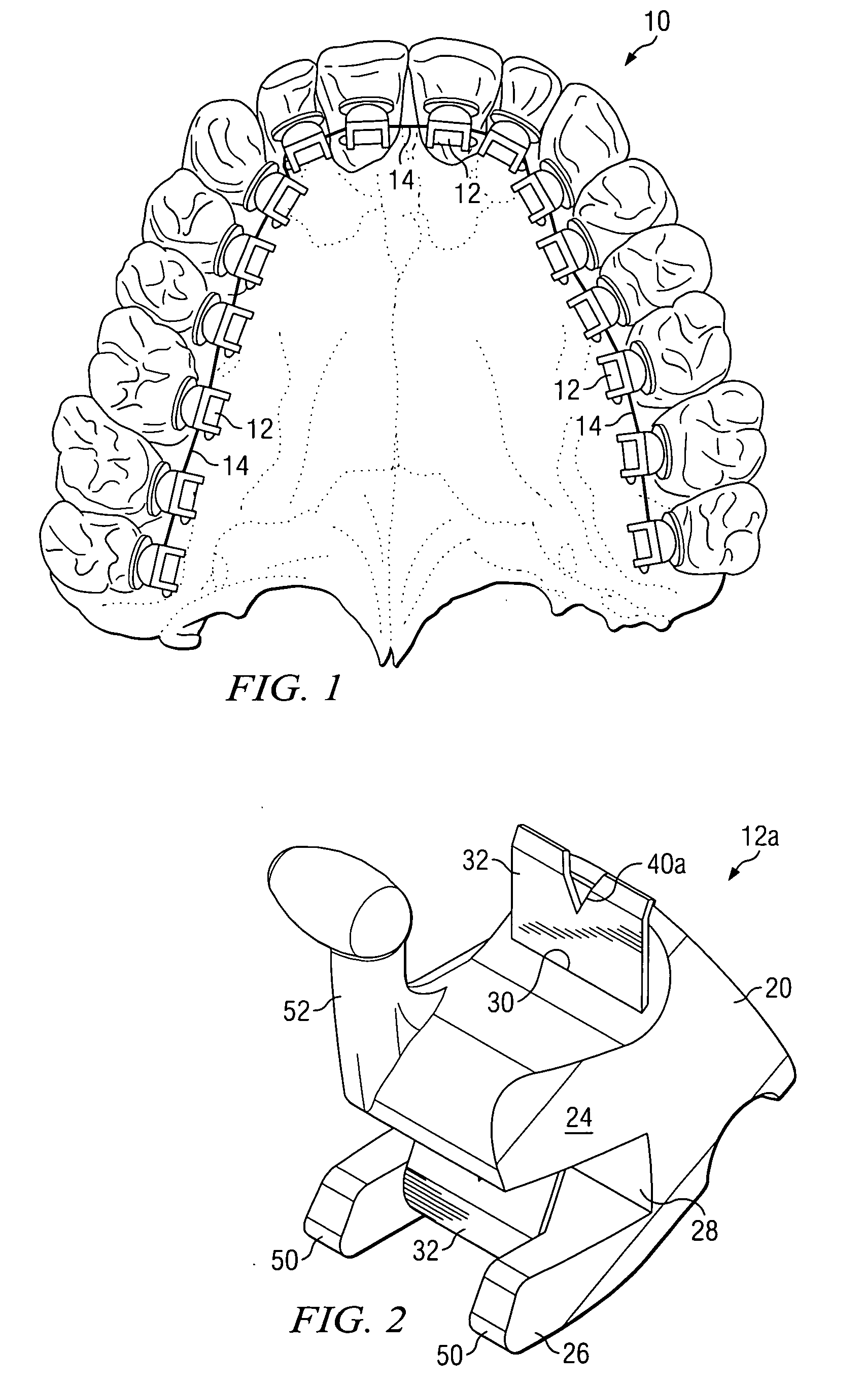 Self-ligating lingual orthodontic bracket