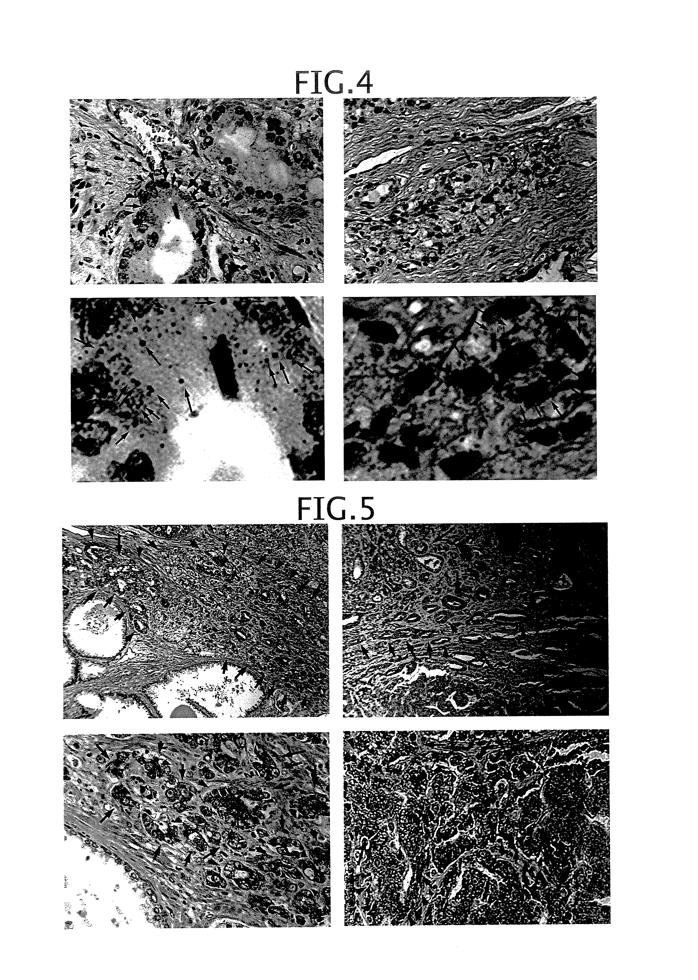 Method and composition for detecting cancer by means of detection of epstein-barr virus nuclear antigen 2 coactivator p100