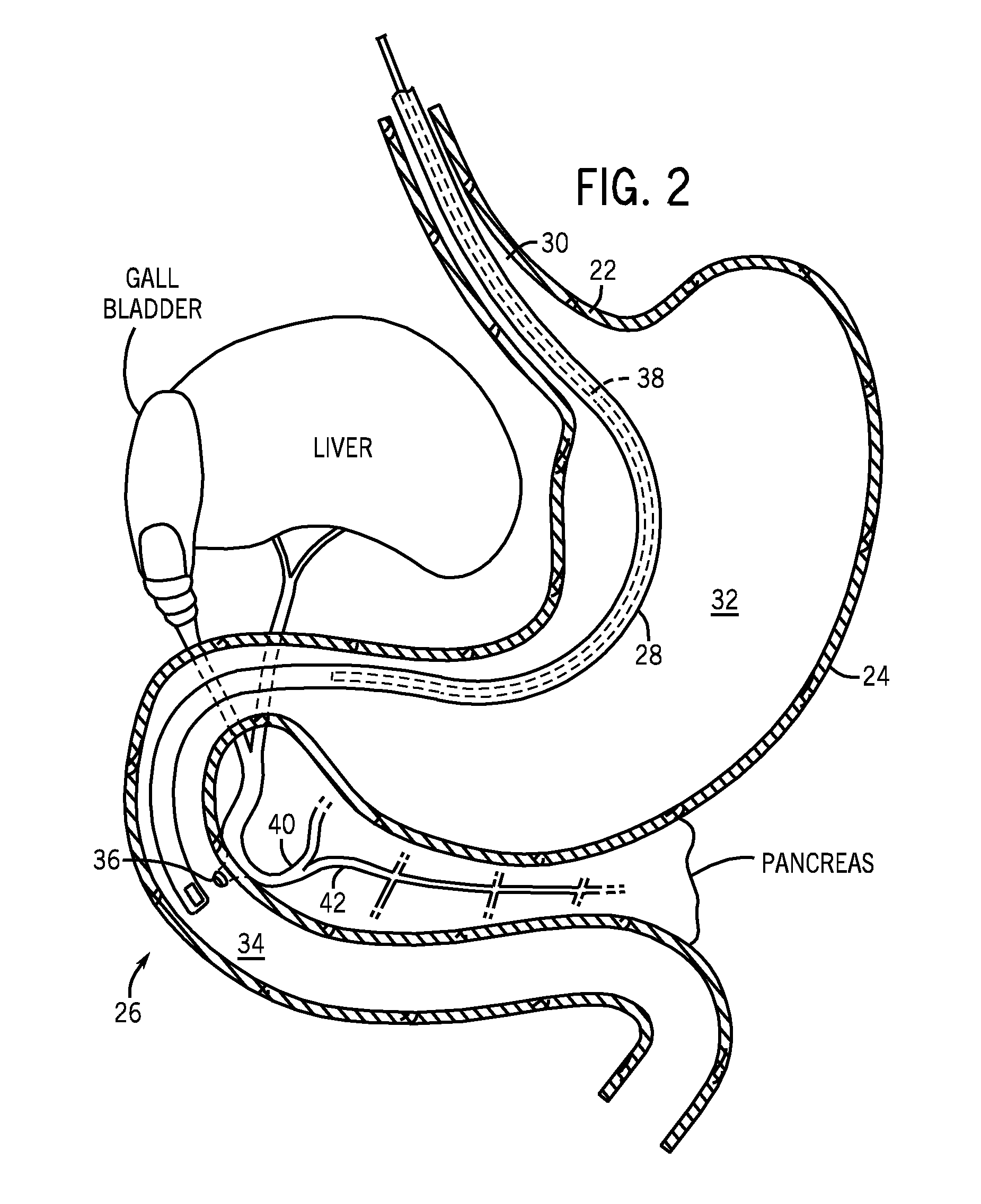 Methods and apparatuses for endoscopic retrograde cholangiopancreatography