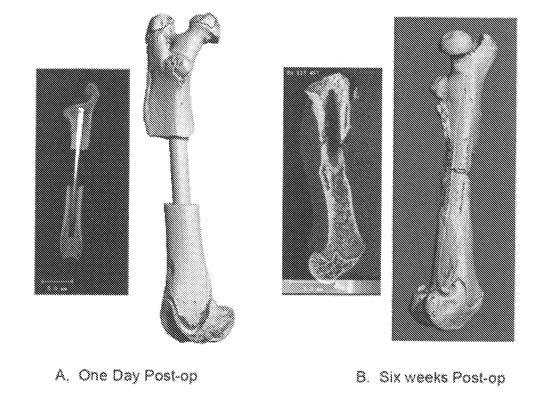 Synthetic bone grafts constructed from carbon foam materials