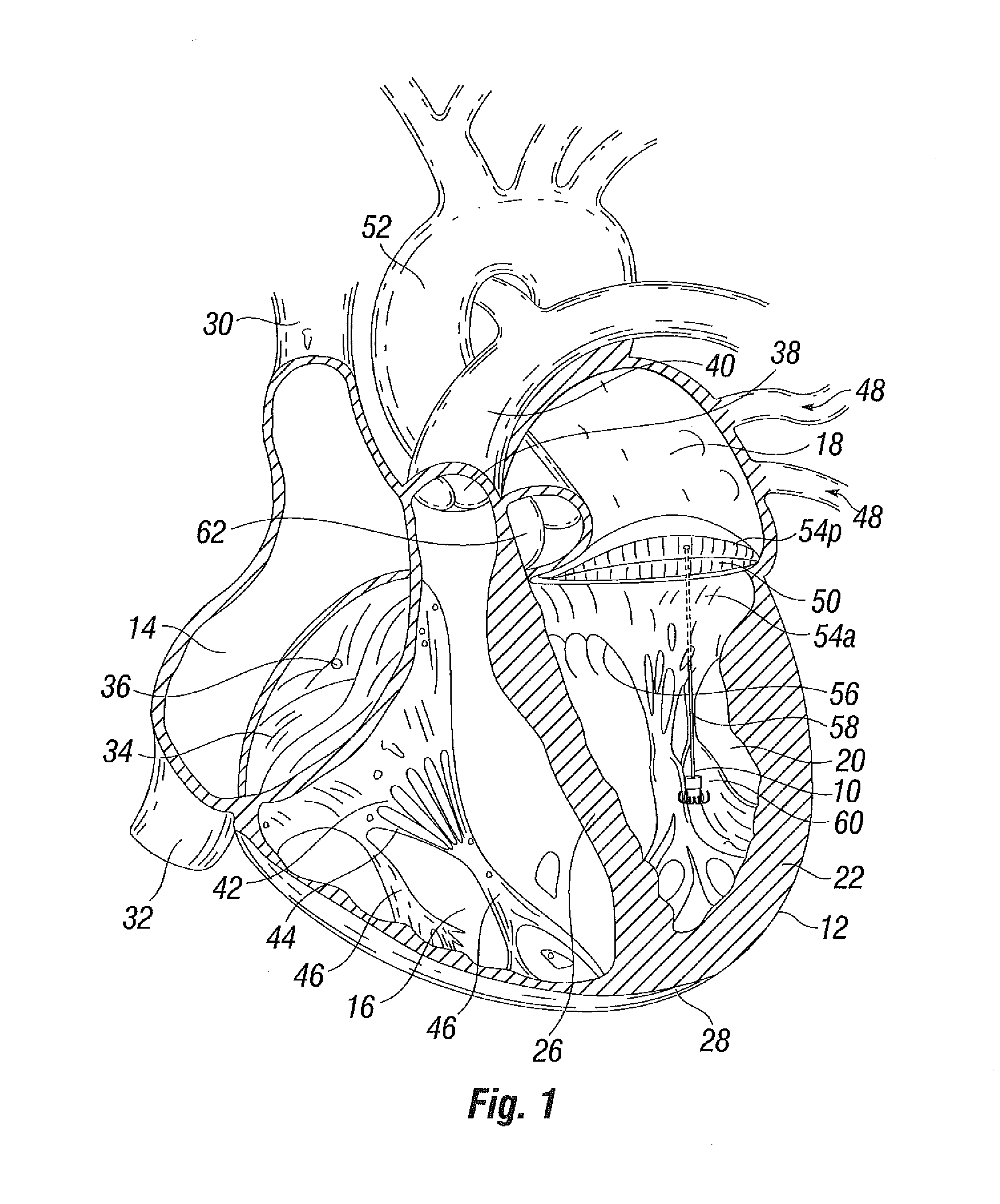 Suture and method for repairing a heart