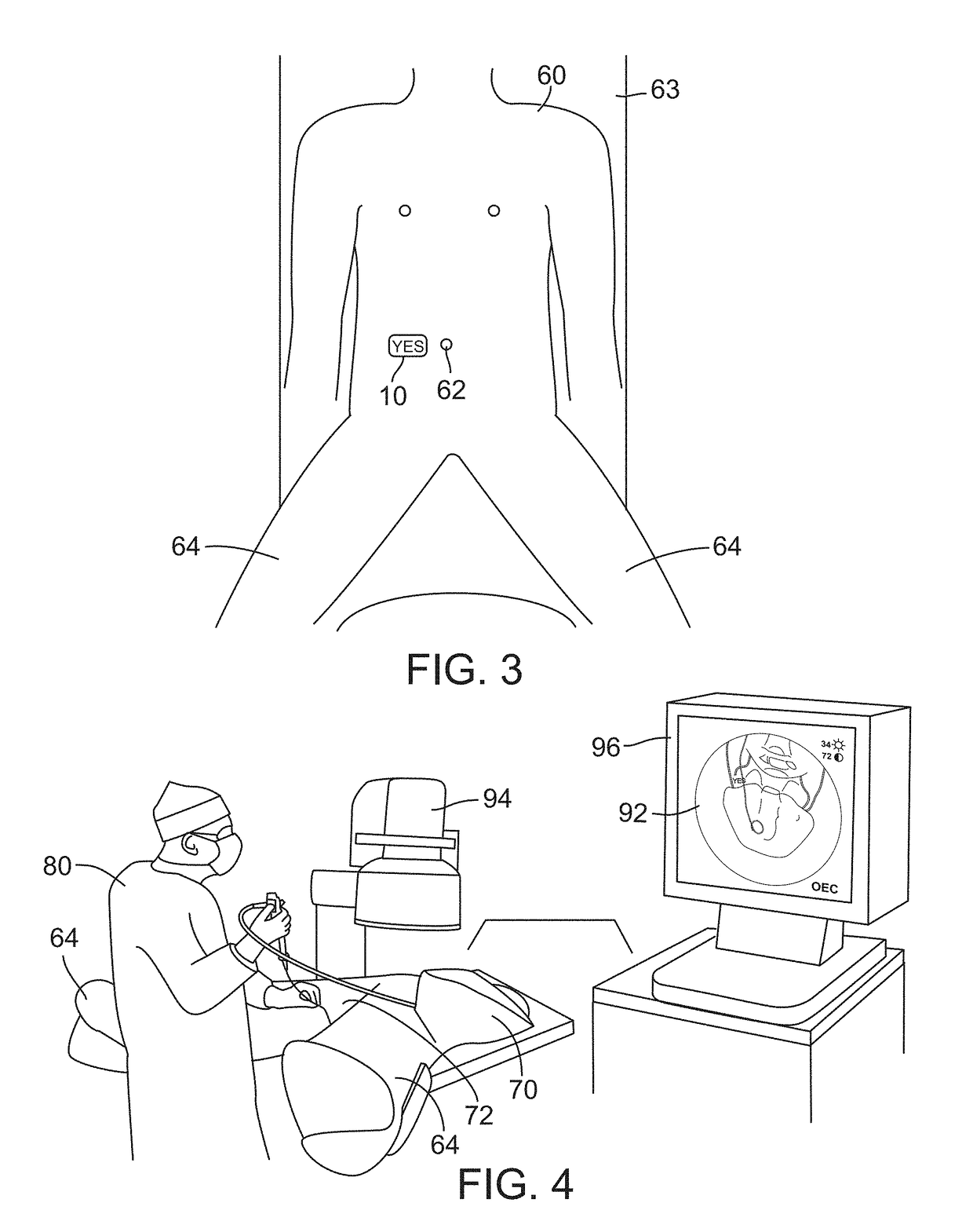 Radiopaque Procedure Site Marker and Method for Intraoperative Medical Imaging