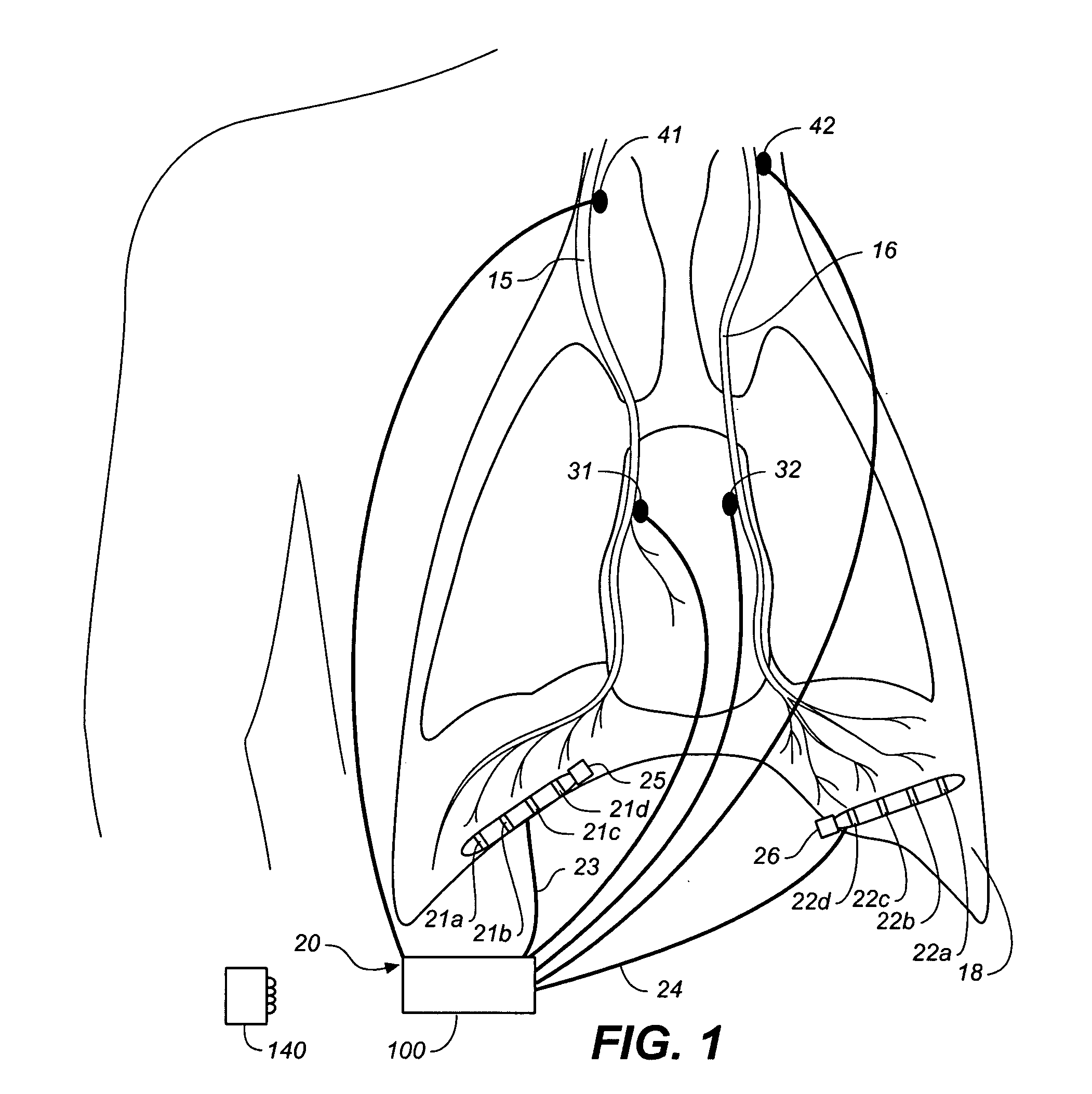 Device and method for biasing lung volume