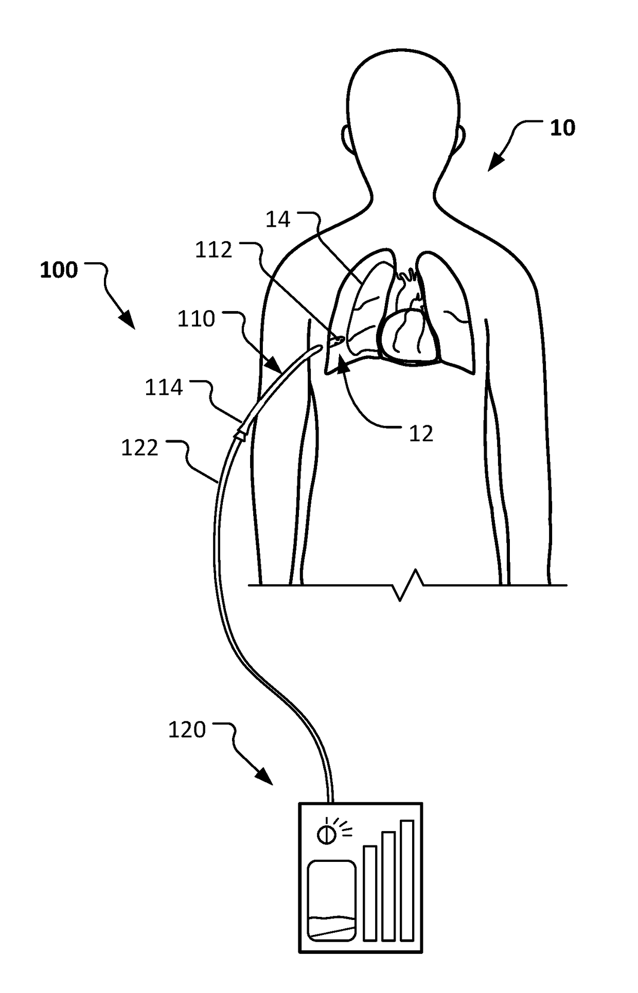 Co2-sensing chest tube and needle thoracostomy devices