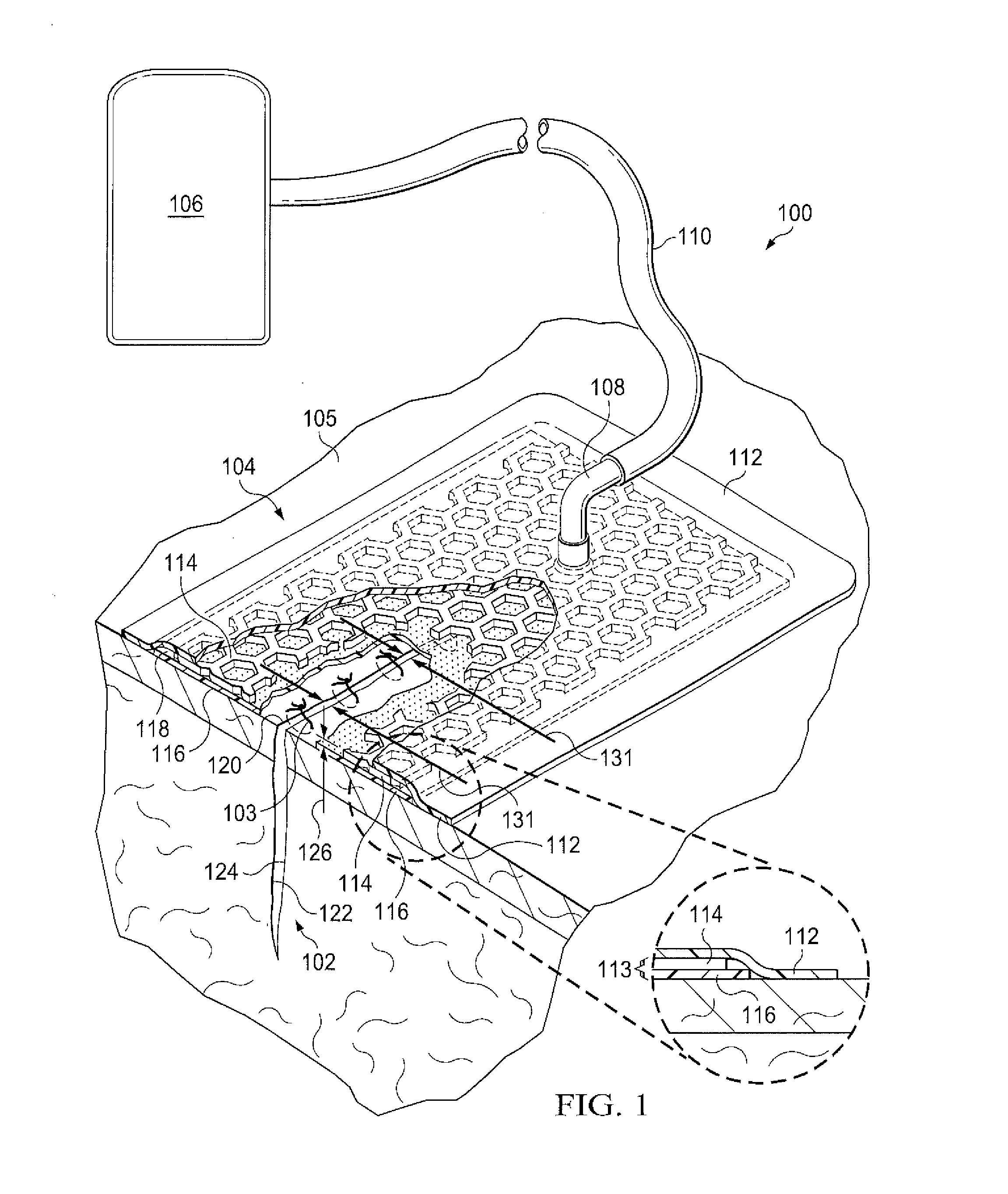 Dressing with contracting layer for linear tissue sites