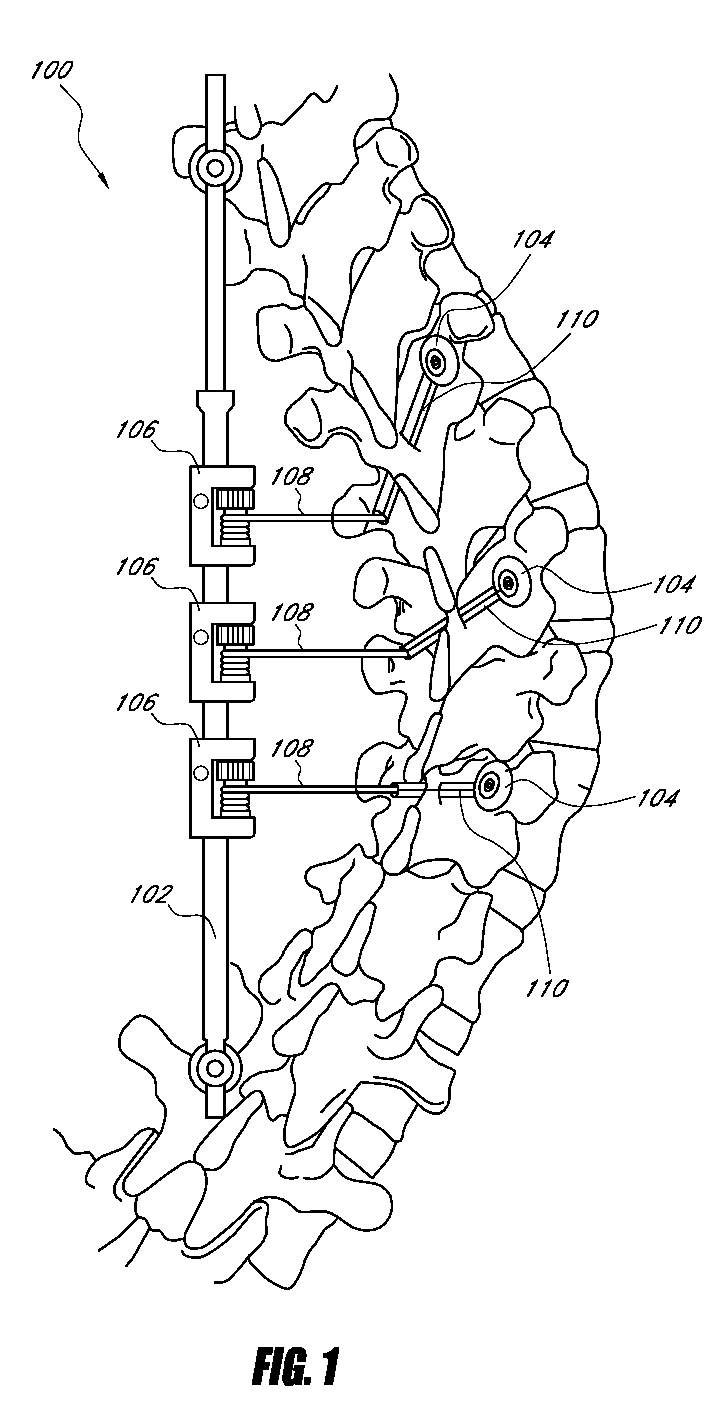 Medical device and method to correct deformity