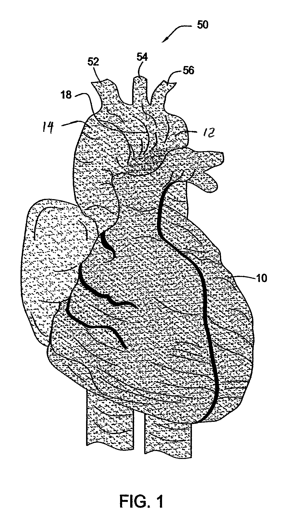 Methods and apparatus for treatment of thoracic aortic aneurysms