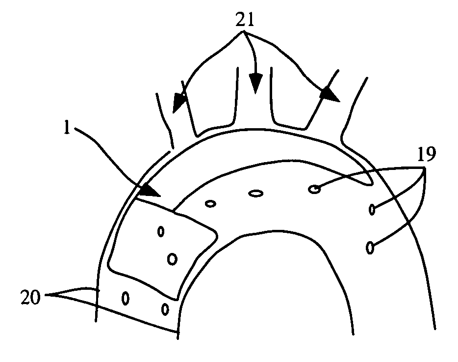 Embolic protection device for the prevention of stroke