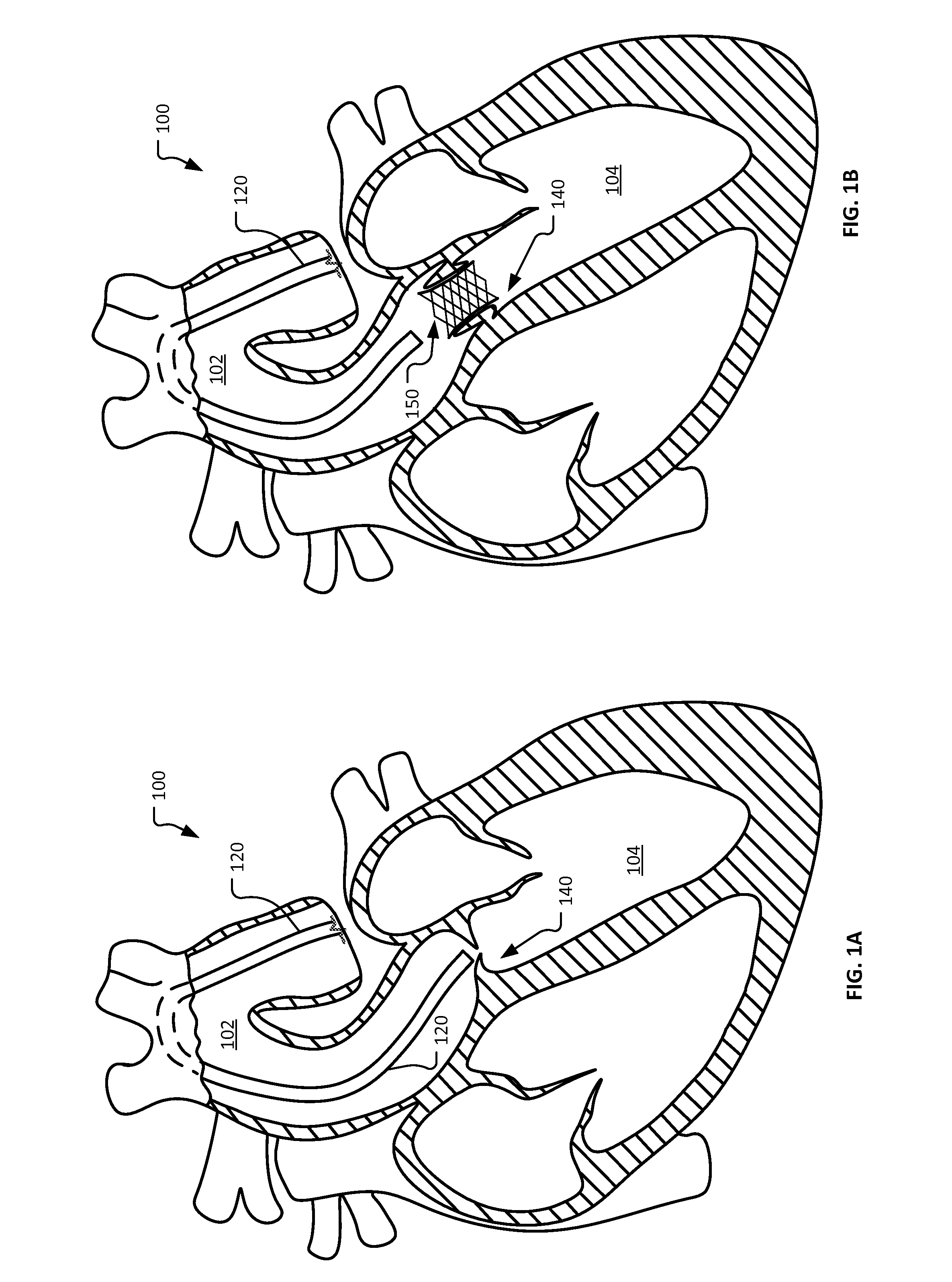 Self-assembling percutaneously implantable heart valve