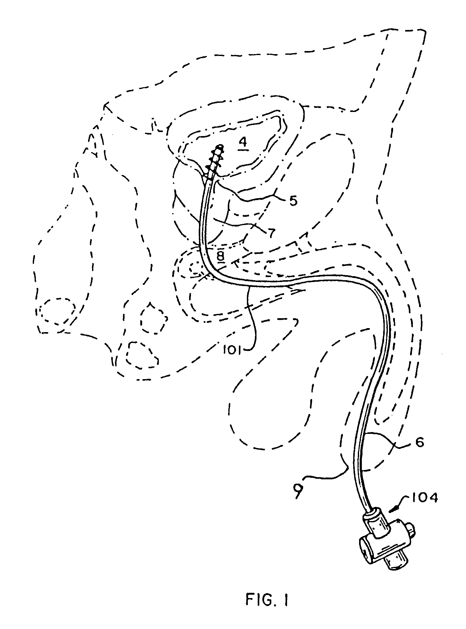 Rotate-to-advance catheterization system