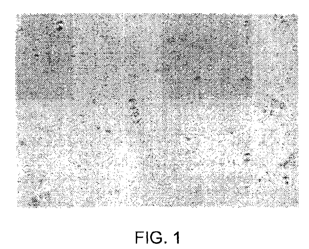 Biphasic lipid-vesicle compositions and methods for treating cervical dysplasia by intravaginal delivery