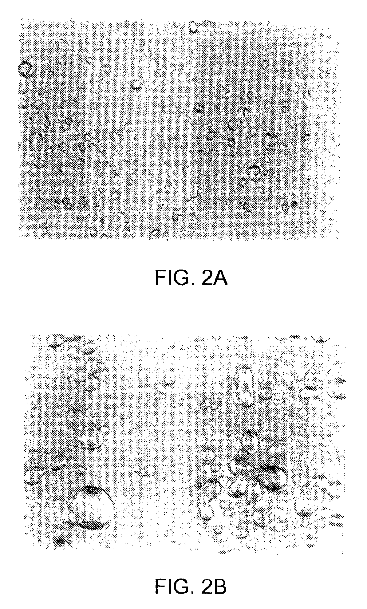 Biphasic lipid-vesicle compositions and methods for treating cervical dysplasia by intravaginal delivery