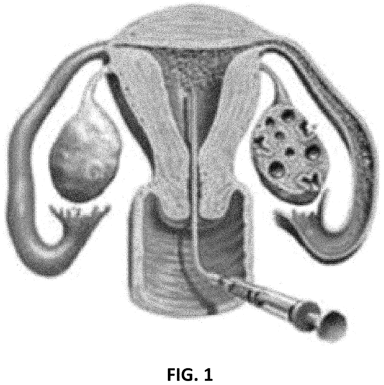 Catheter ultrasound transmission element (CUTE) catheter