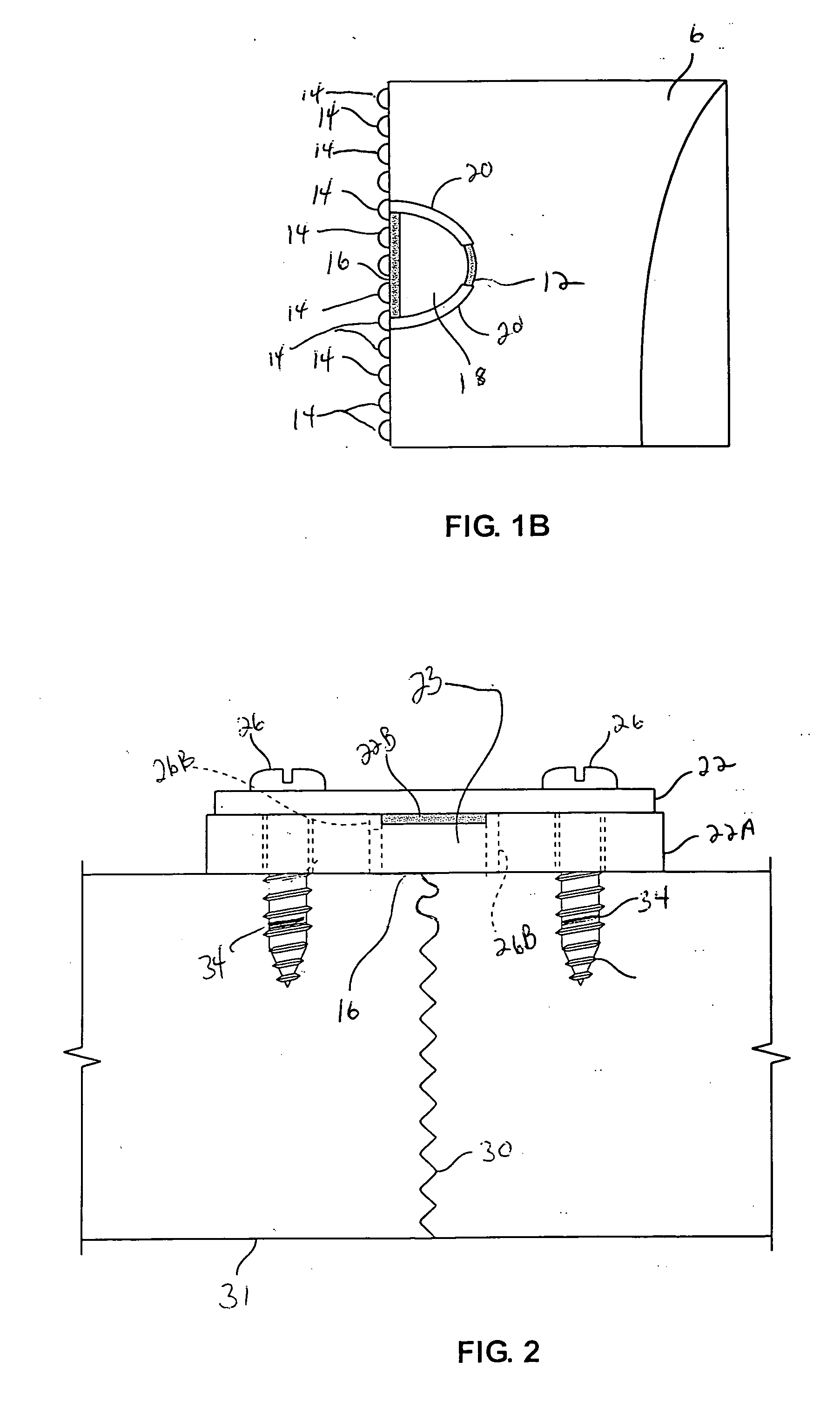 Implanted prosthetic device