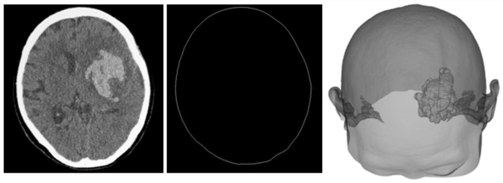 A 3D Visual Scalp Craniotomy Positioning Method Combined with Optical Surgical Navigation