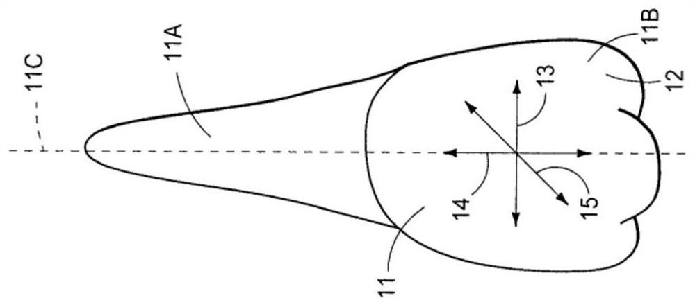 Orthodontic bracket apparatus and method for treating malocclusion