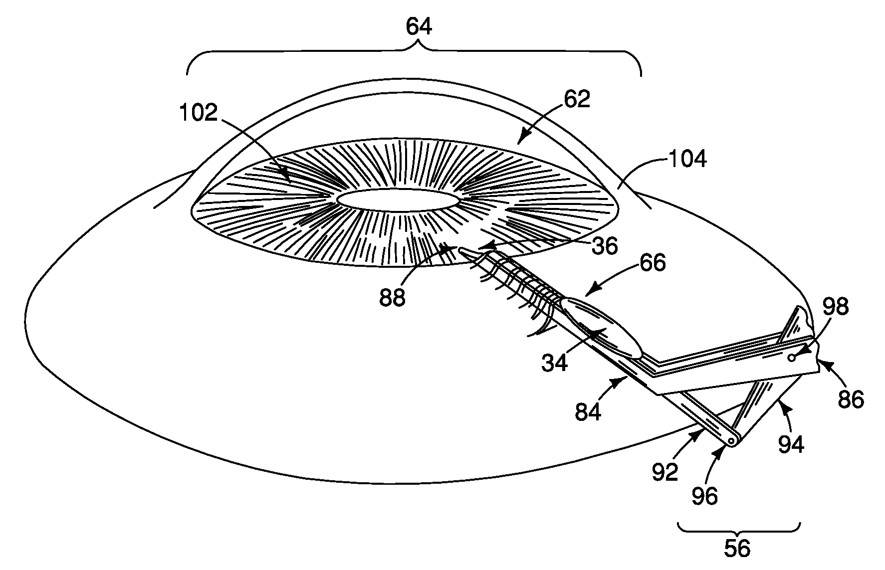 Method and apparatus for reducing intraocular pressure