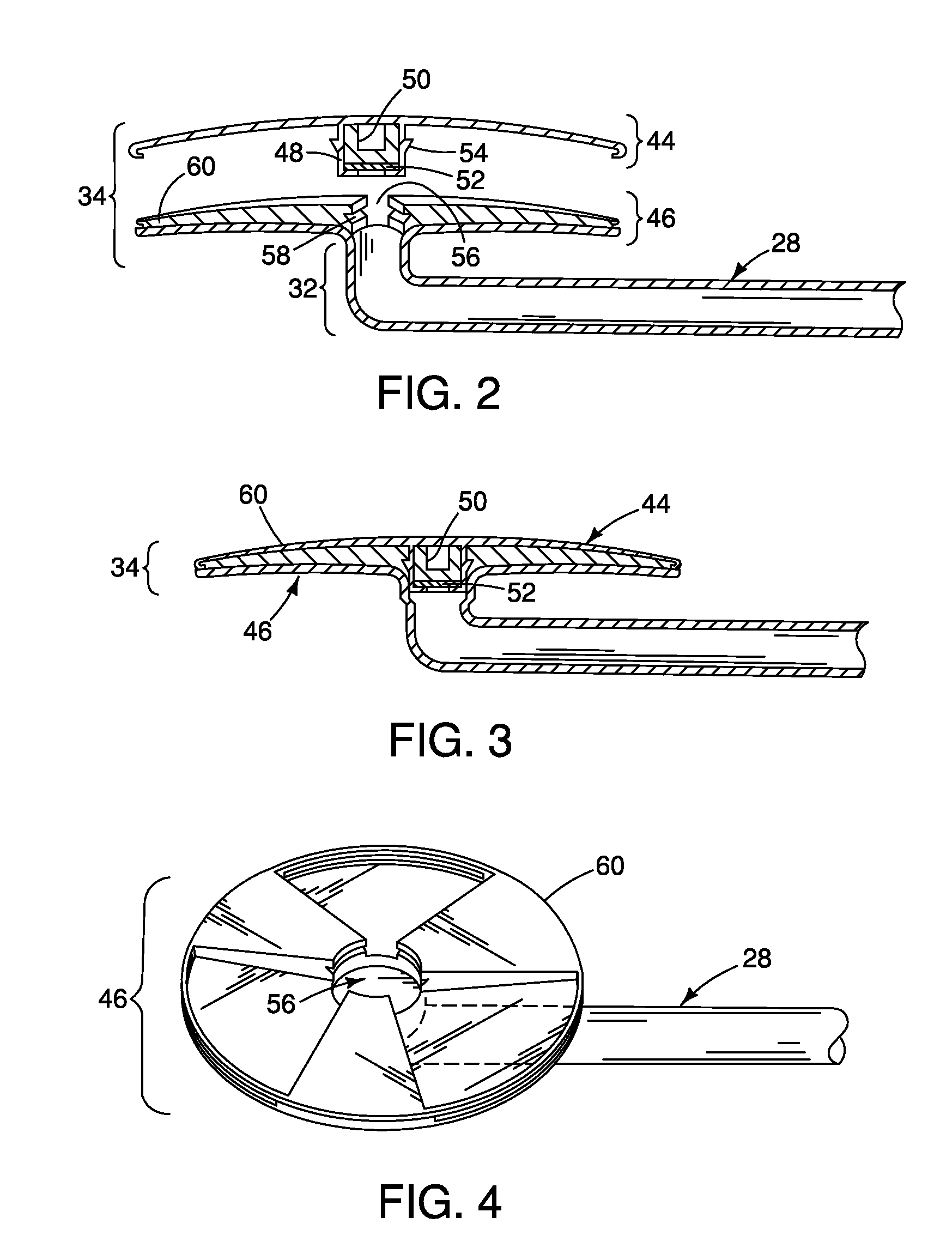 Method and apparatus for reducing intraocular pressure