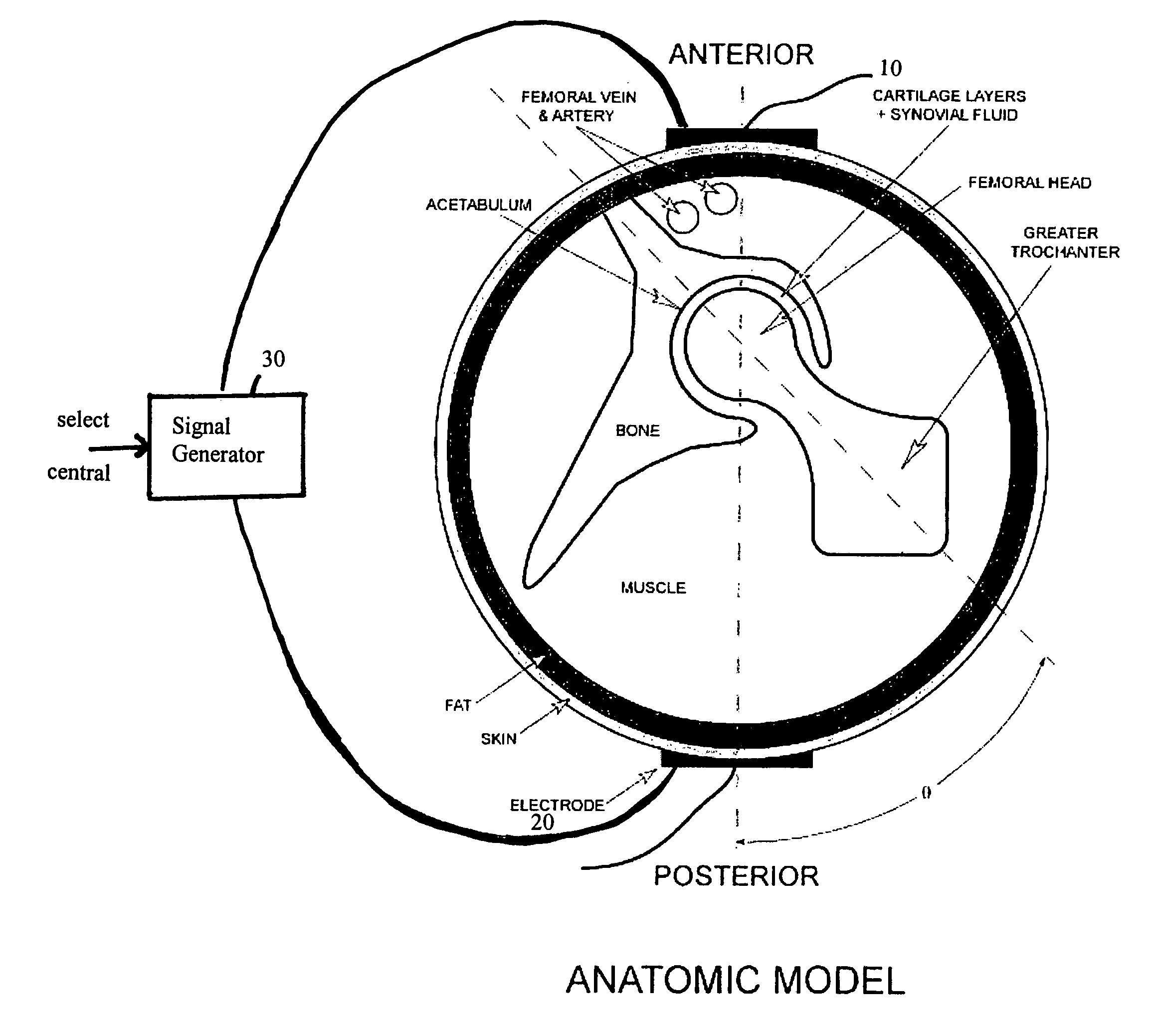 Method and device for treating osteoarthritis and cartilage disease, defects, and injuries in the human hip