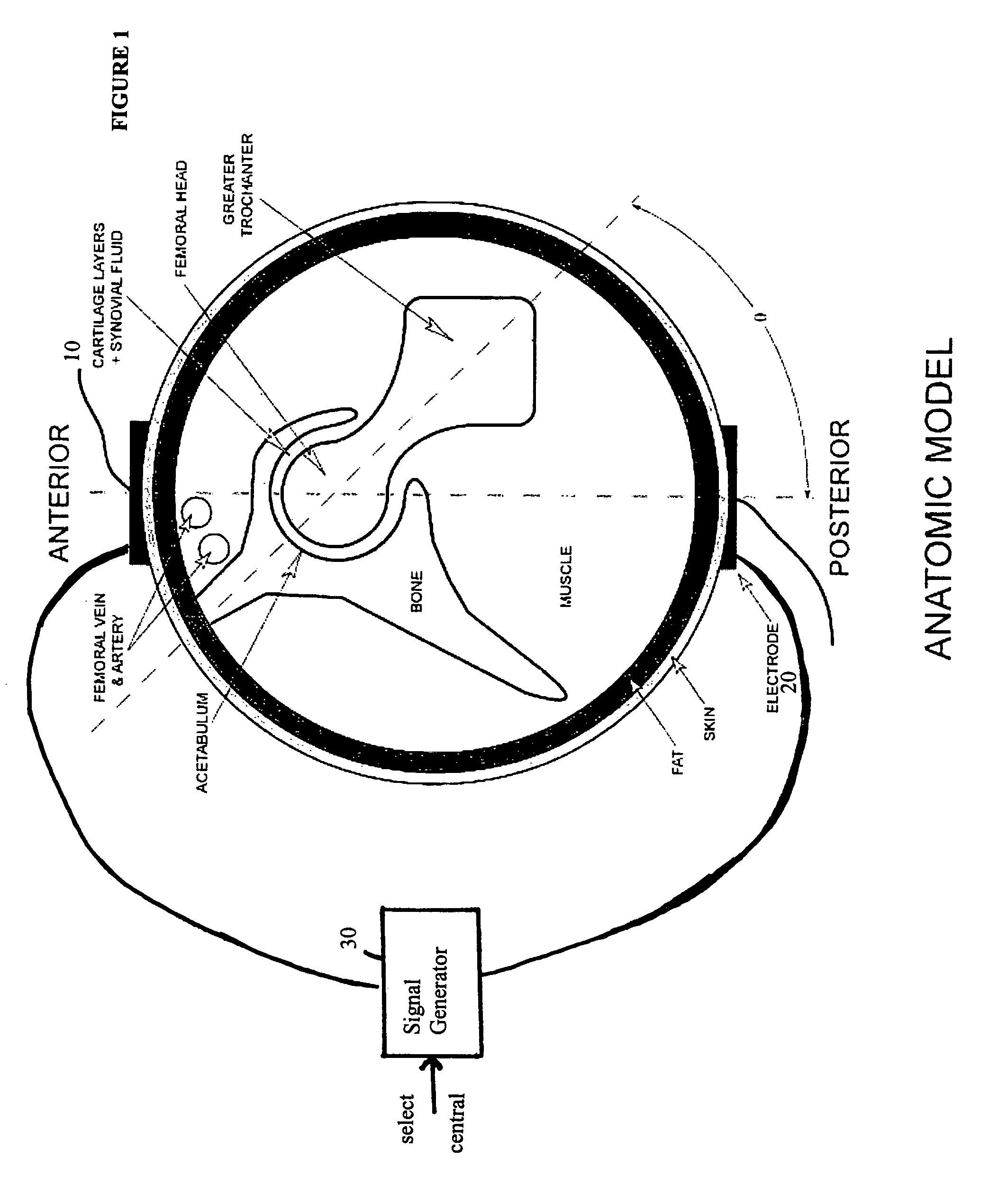 Method and device for treating osteoarthritis and cartilage disease, defects, and injuries in the human hip