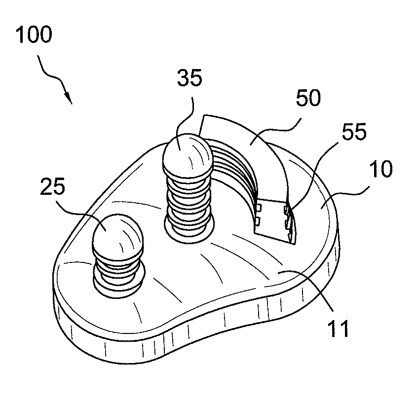 Hybrid glenoid for shoulder arthroplasty