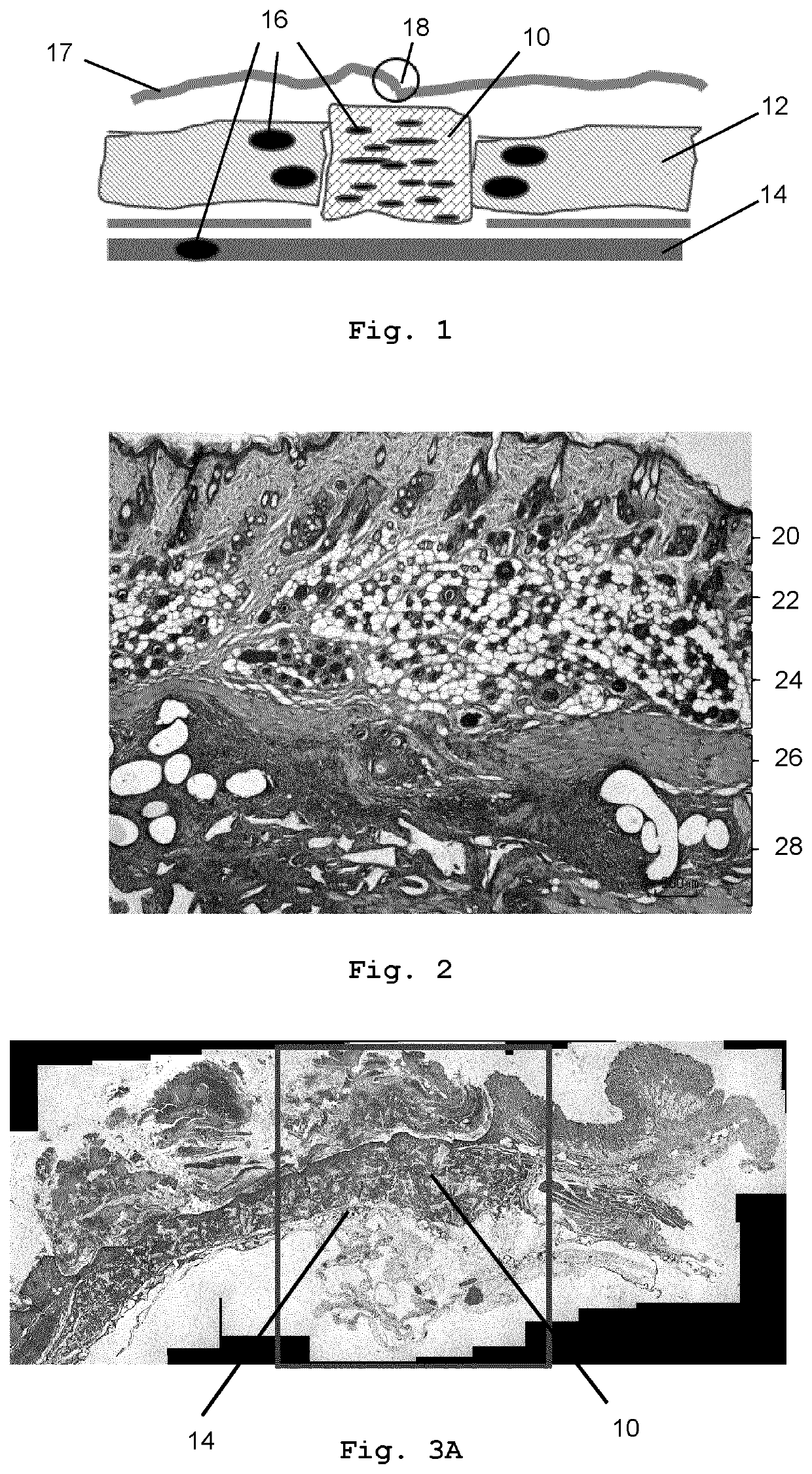 Biodegradable Mesh Implant for Soft Tissue Repair