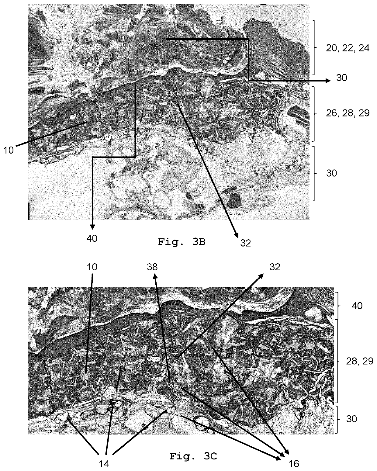 Biodegradable Mesh Implant for Soft Tissue Repair