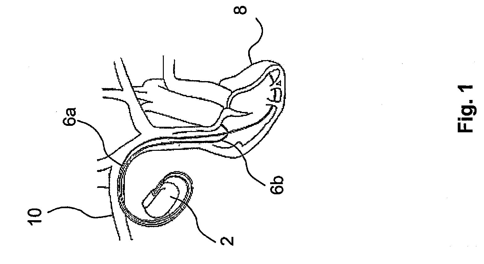 Implantable Medical Device with Therapy Control