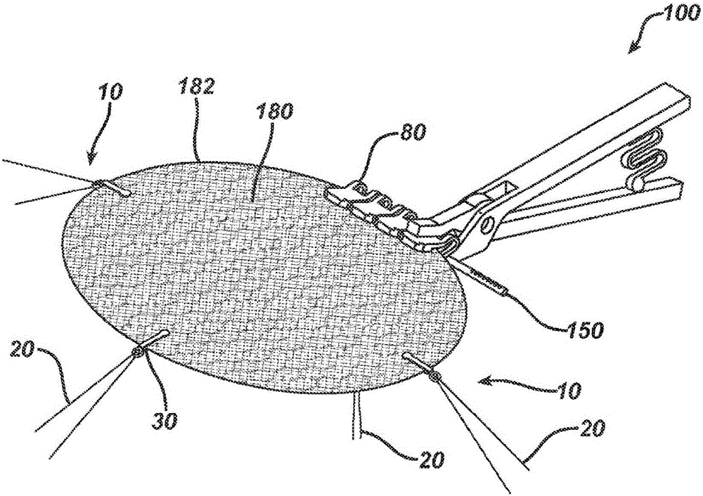 Method and means to attach anchor sutures onto mesh implants