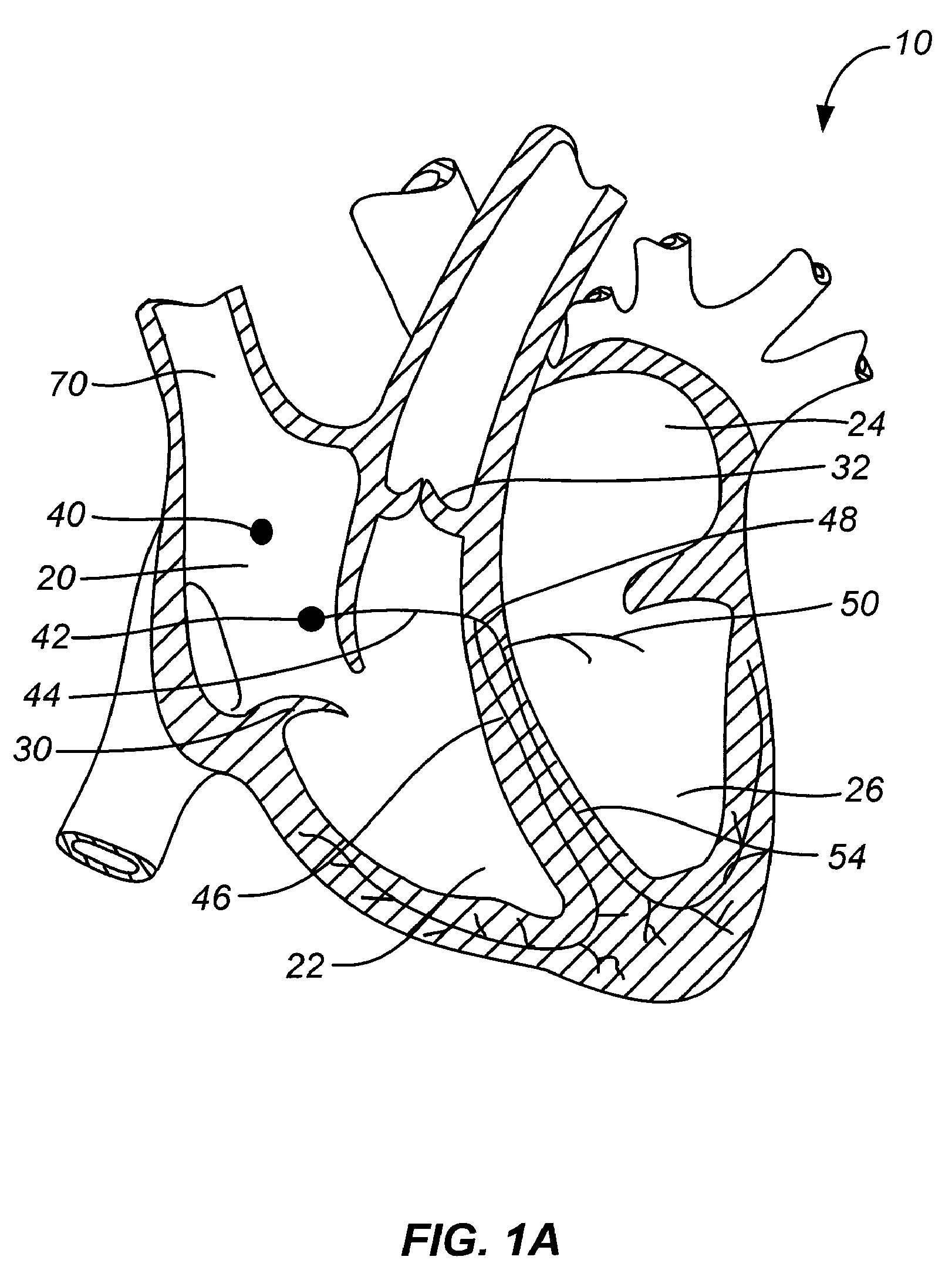 Transcoronary sinus pacing system, LV summit pacing, early mitral closure pacing, and methods therefor