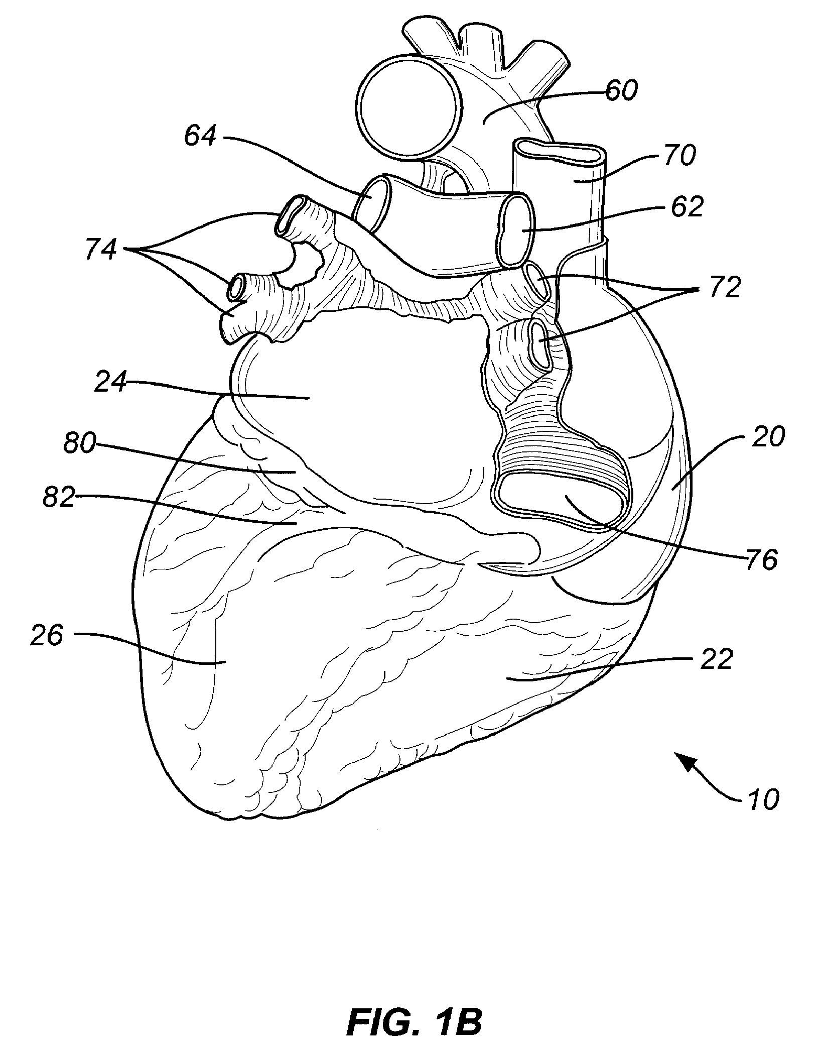 Transcoronary sinus pacing system, LV summit pacing, early mitral closure pacing, and methods therefor