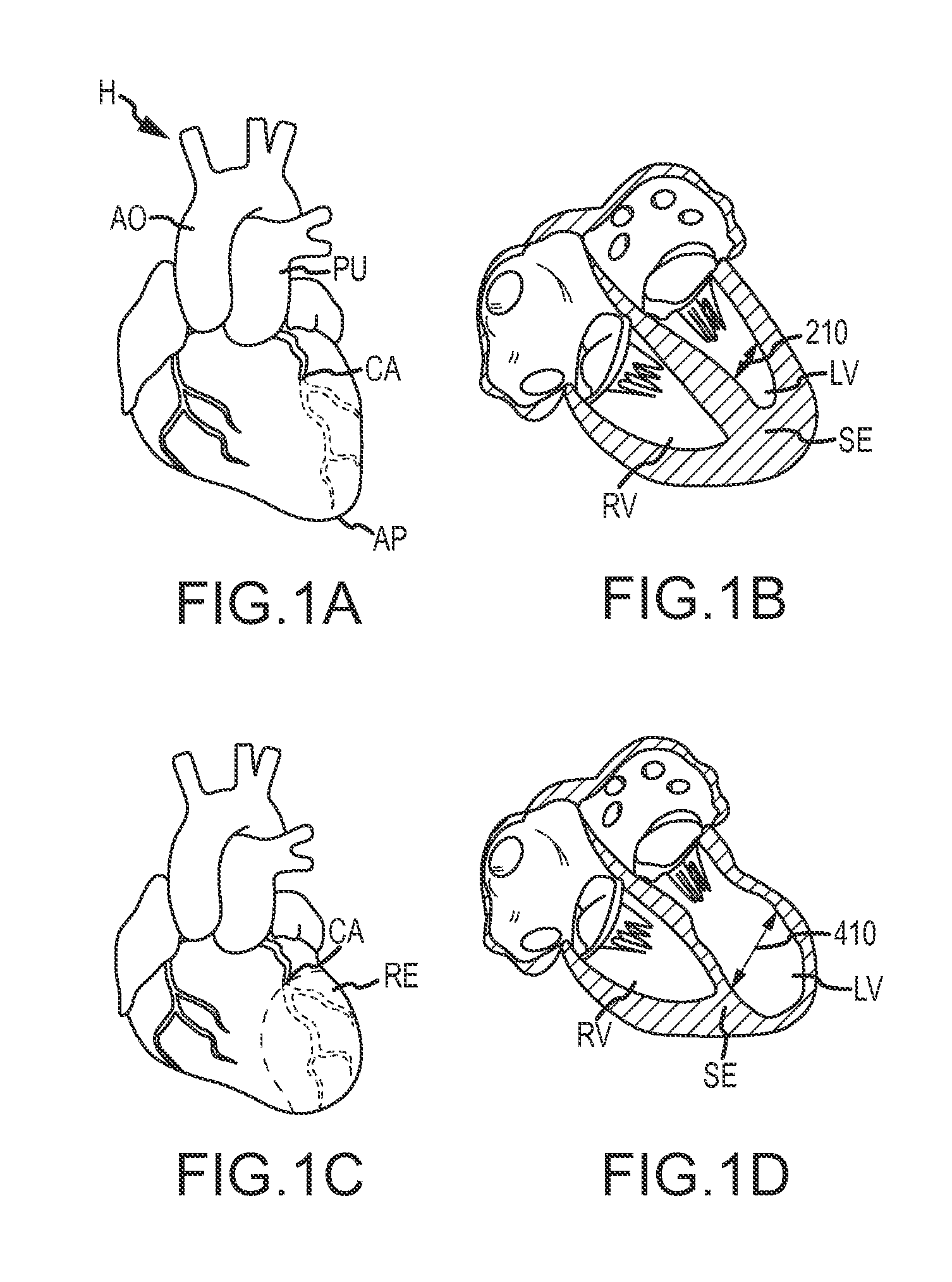 Over-the-wire cardiac implant delivery system for treatment of chf and other conditions