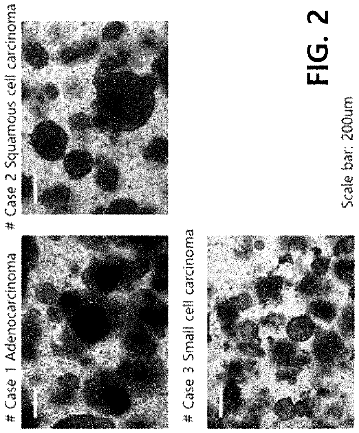 Method for culturing 3-dimensional lung cancer organoid and method for preparing patient-derived xenograft animal model using same