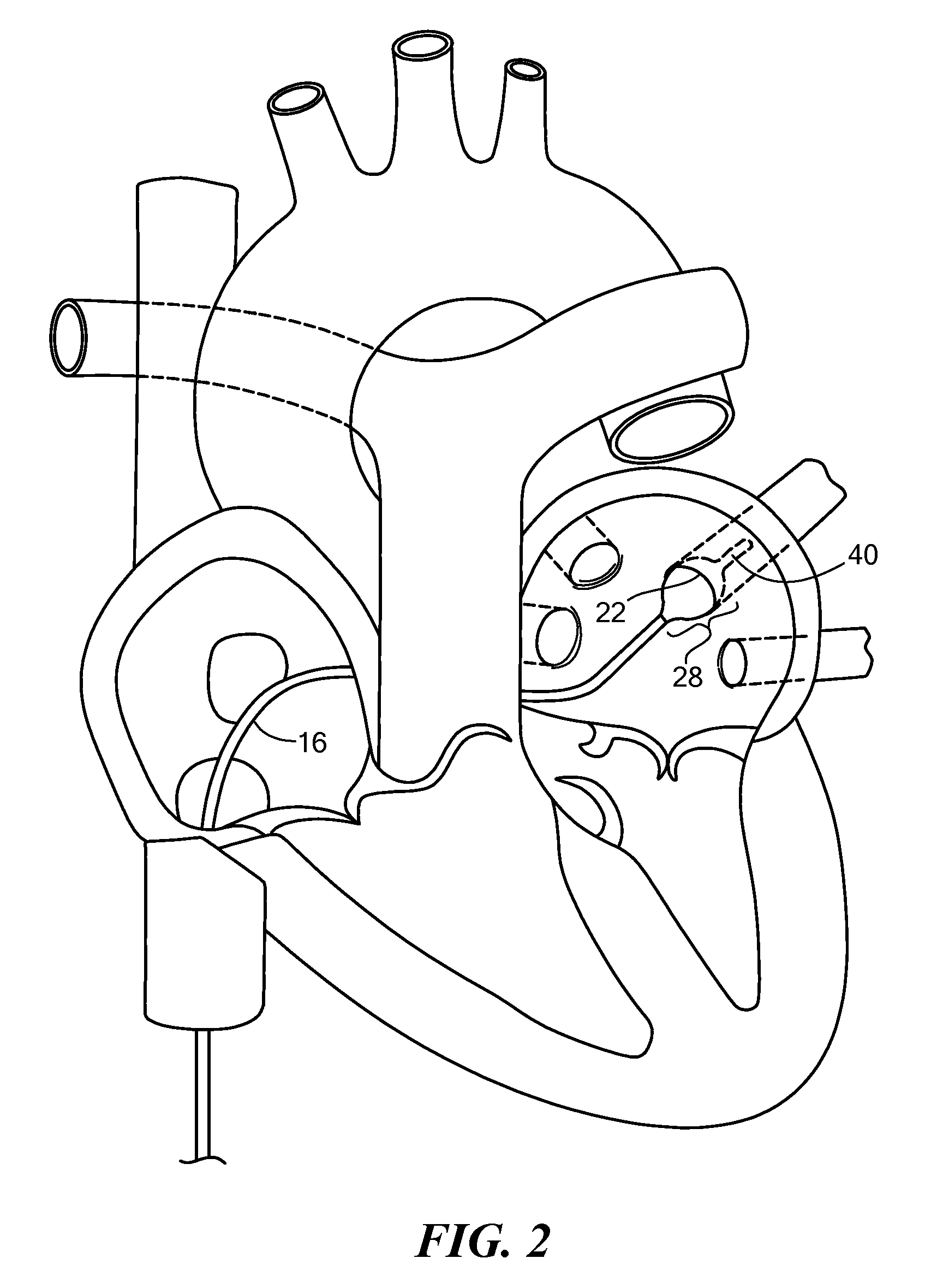 Cryogenic balloon device with radiofrequency tip