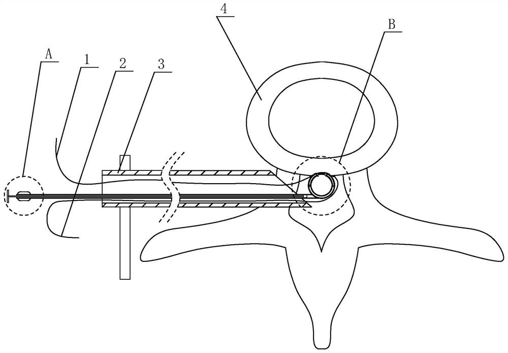 Annulus fibrosus suturing device and its suturing method after intervertebral disc herniation