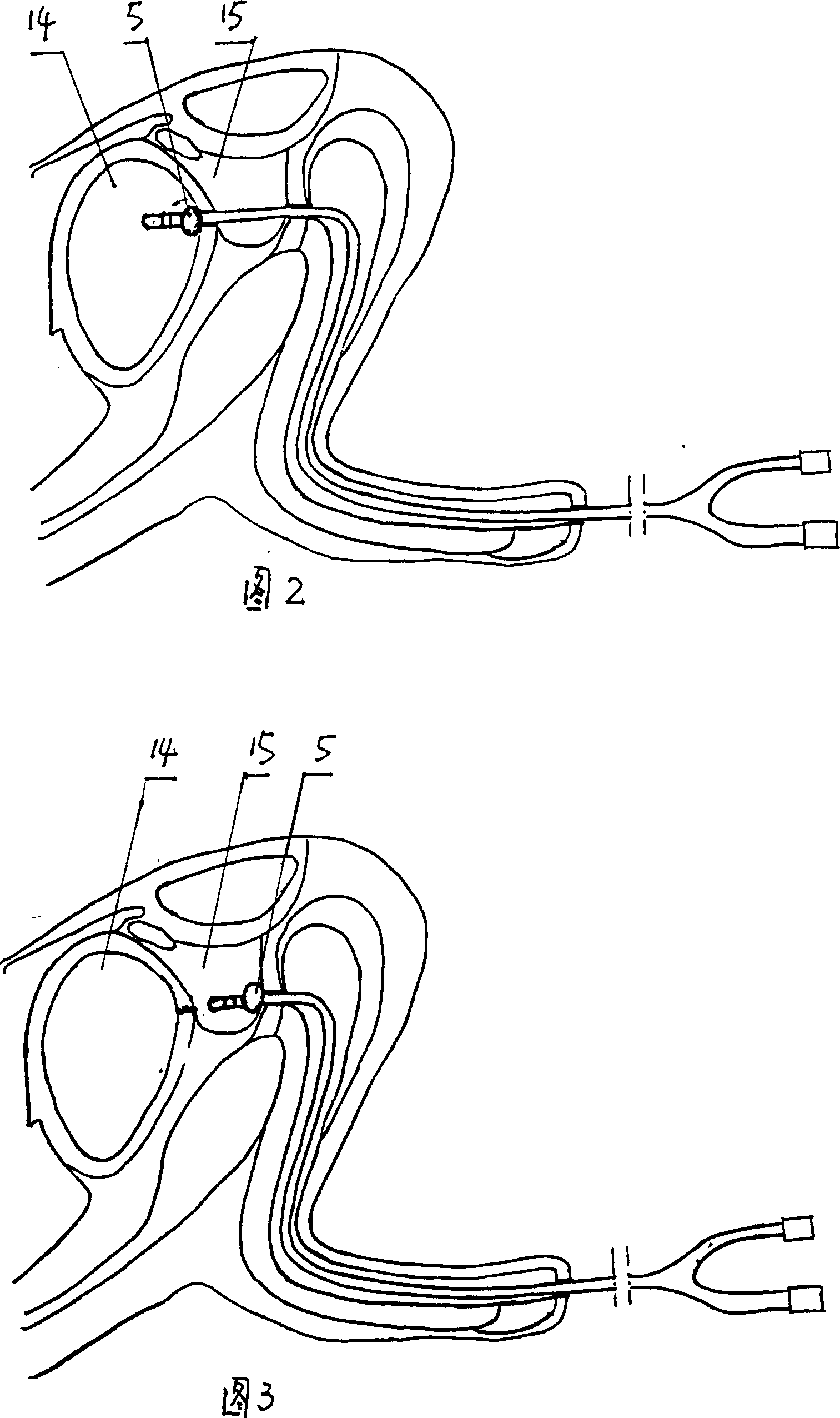 Prostate urethra medicine-infusion washing drainage tube