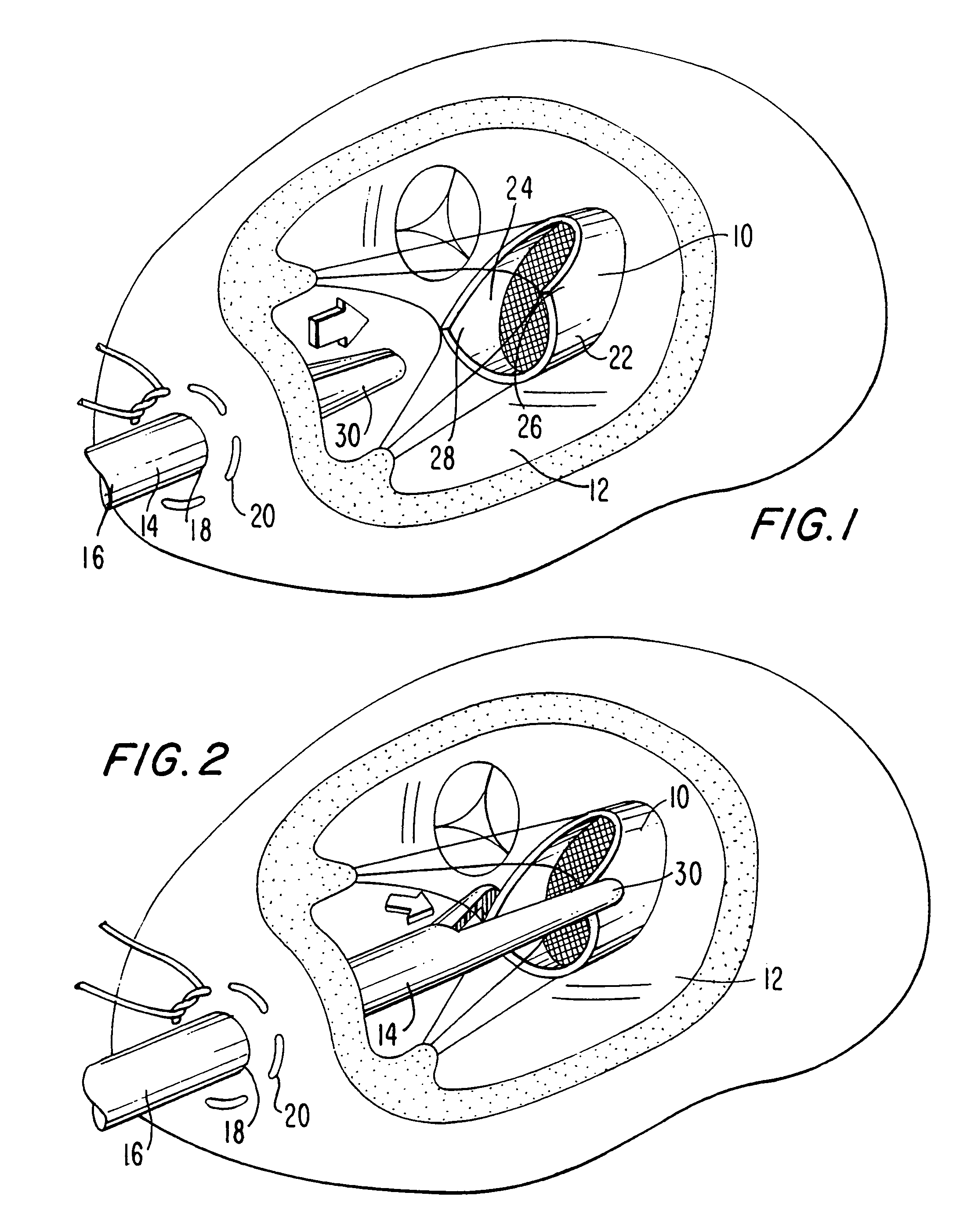 Method and apparatus for circulatory valve repair