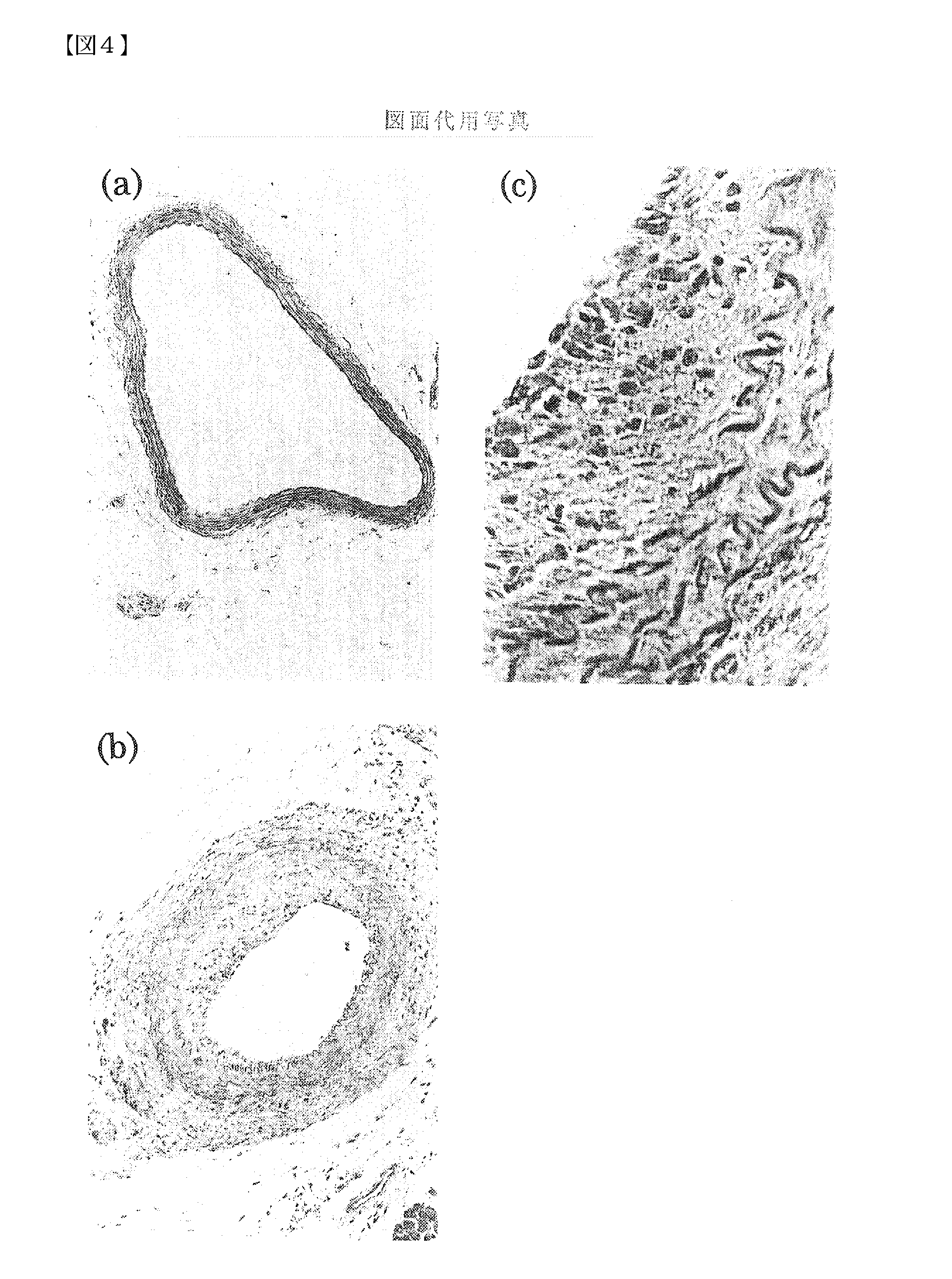 Pharmaceutical Compositions for the Prevention and Treatment of Atherosclerosis and Restenosis After PTCA