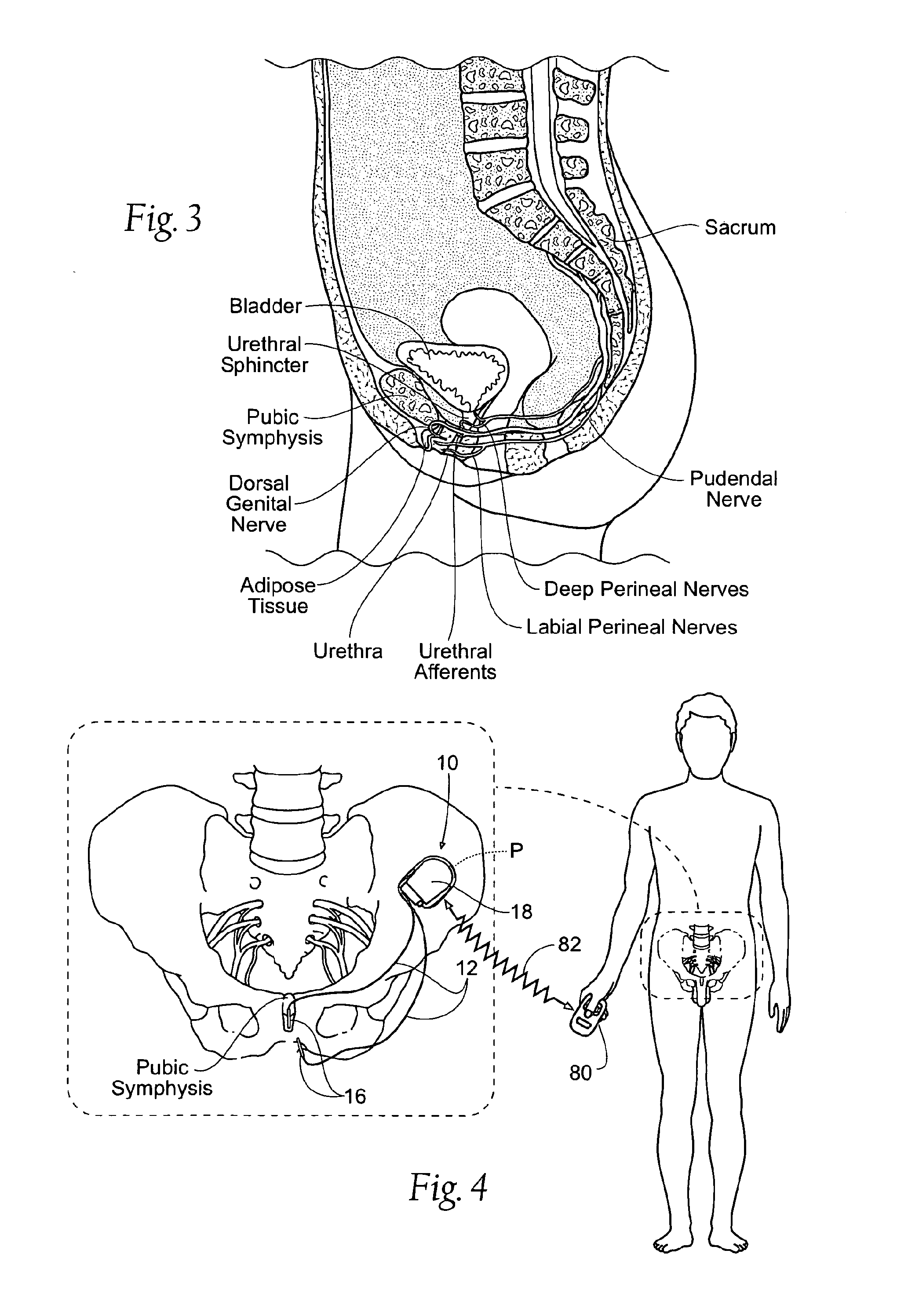 Systems and methods for the treatment of bladder dysfunctions using neuromodulation