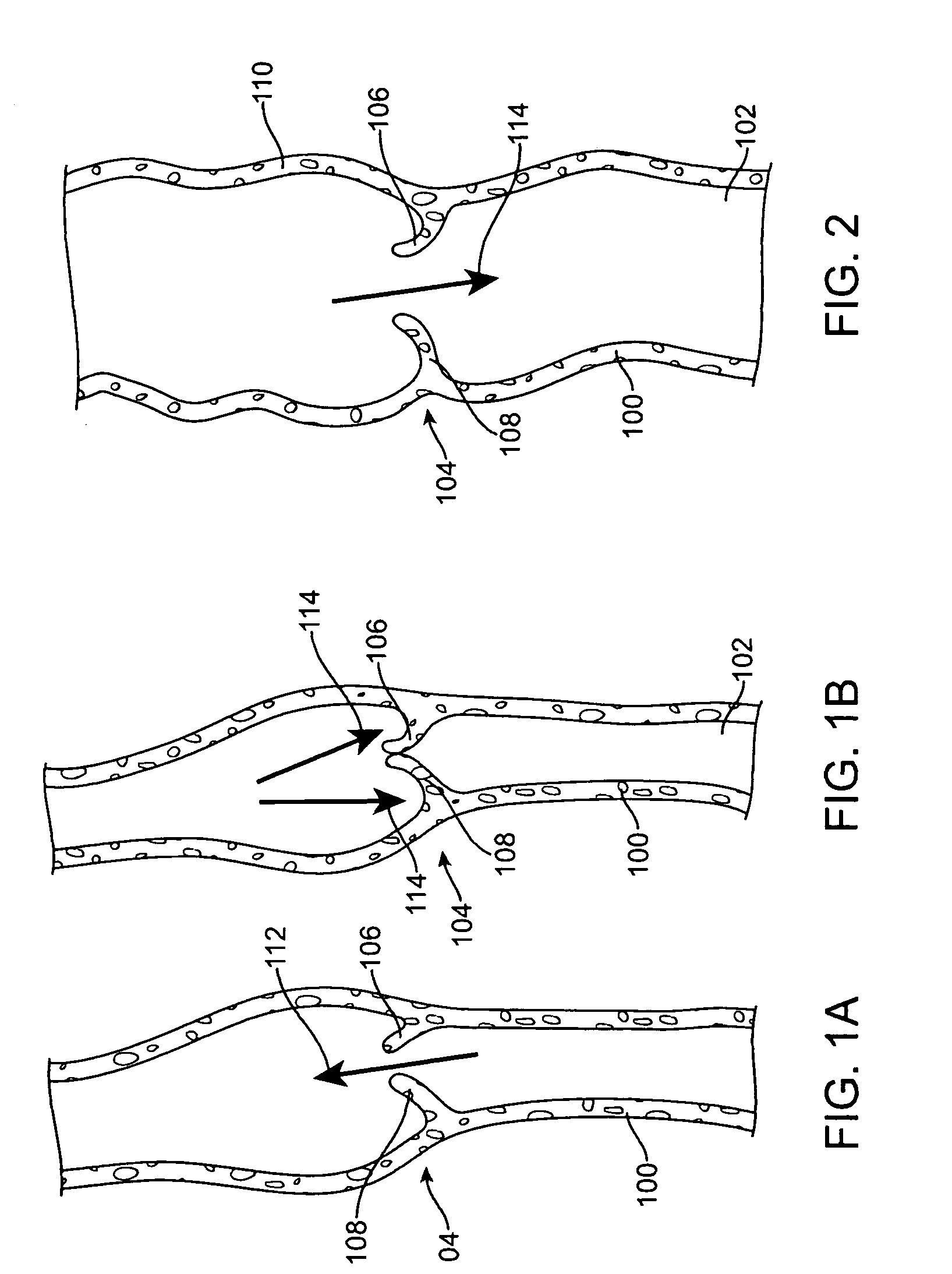 Apparatus for percutaneously creating native tissue venous valves